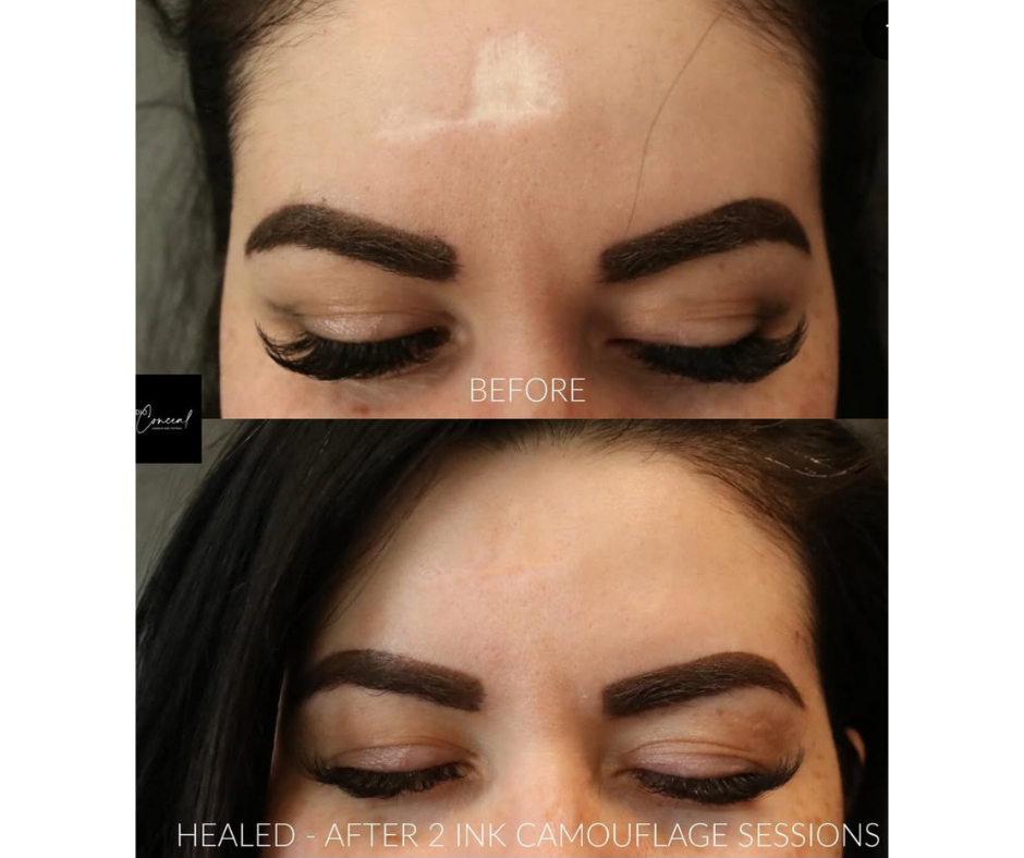 Healed surgical scar camouflage using paramedical tattooing in Reno NV