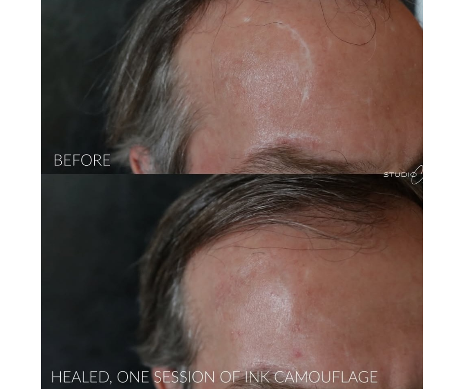 Healed surgical scar camouflage using paramedical tattooing in Reno NV