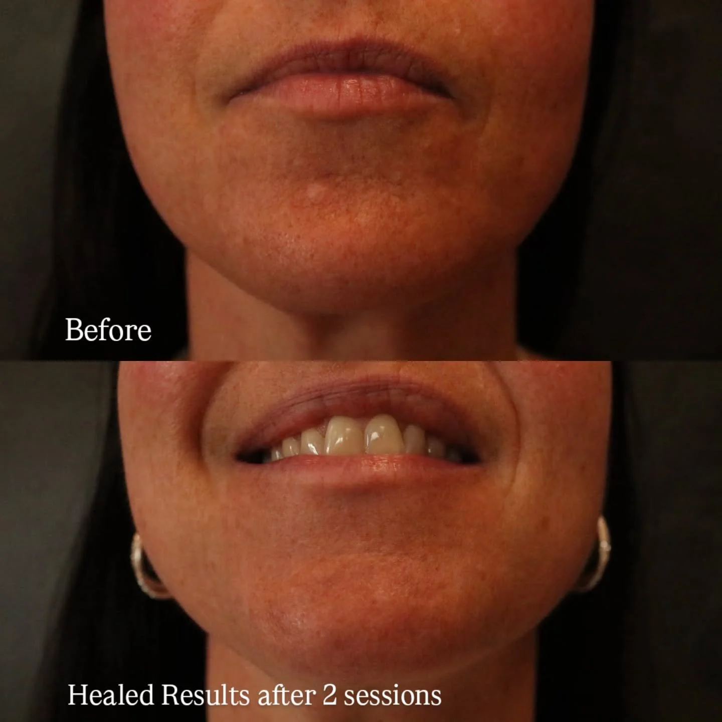 What a Beaut. 
Check out my client's healed chin scar results. 
This may be a small scar, but it screams big results and she can't stop smiling about it. 
No more makeup coverage baby!