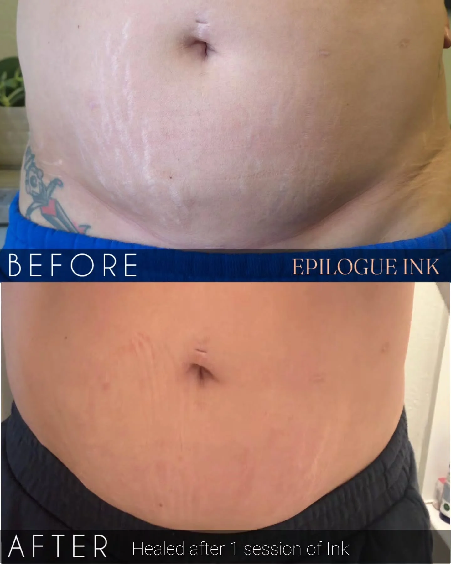 Progress like this deserves a spotlight!

This client will likely need 1&ndash;2 more sessions, but the improvement already is incredible. The coverage alone is a win &mdash; however, the real flex is the depth reduction. These have shrunken so much 