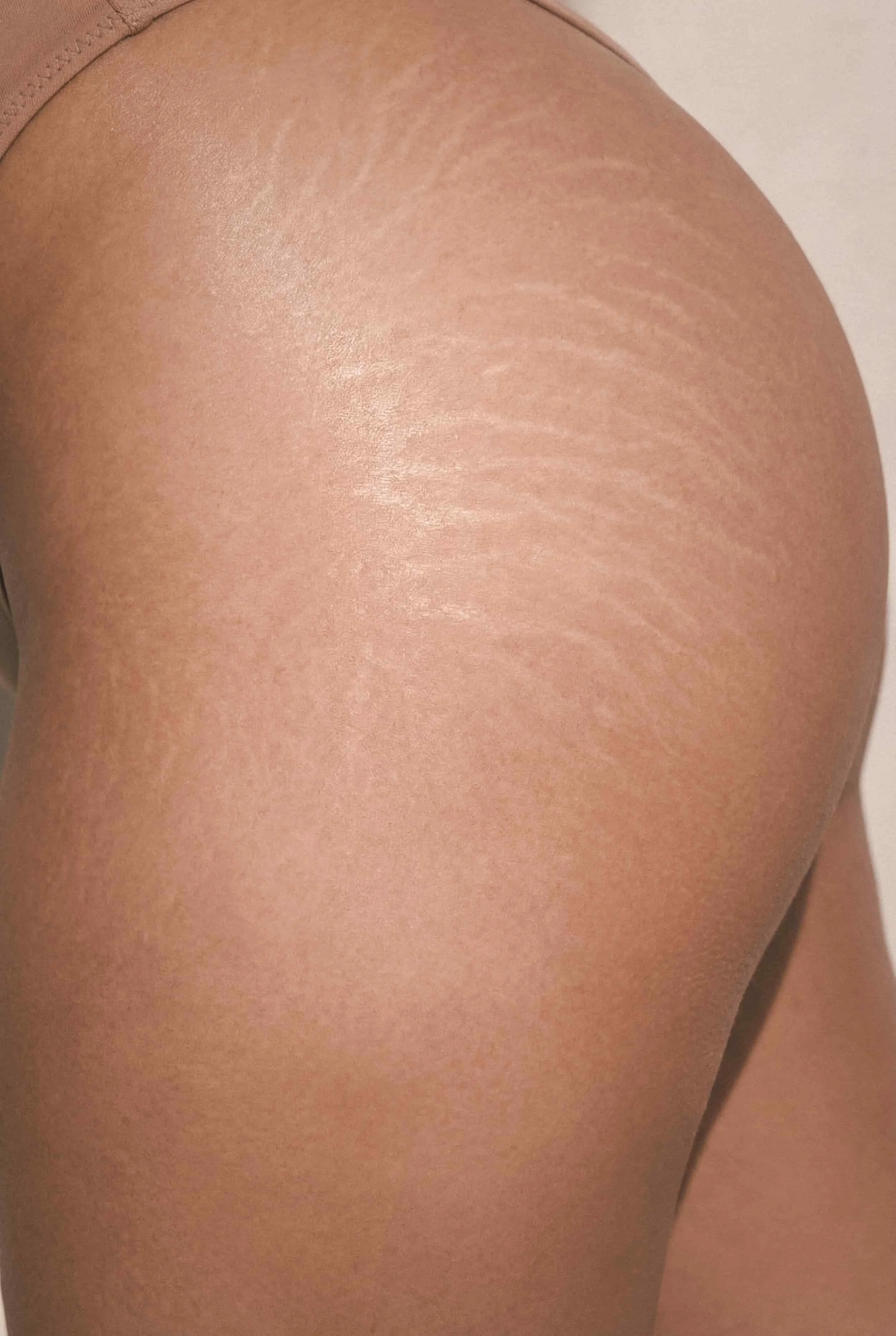 Stretch Mark Restoration