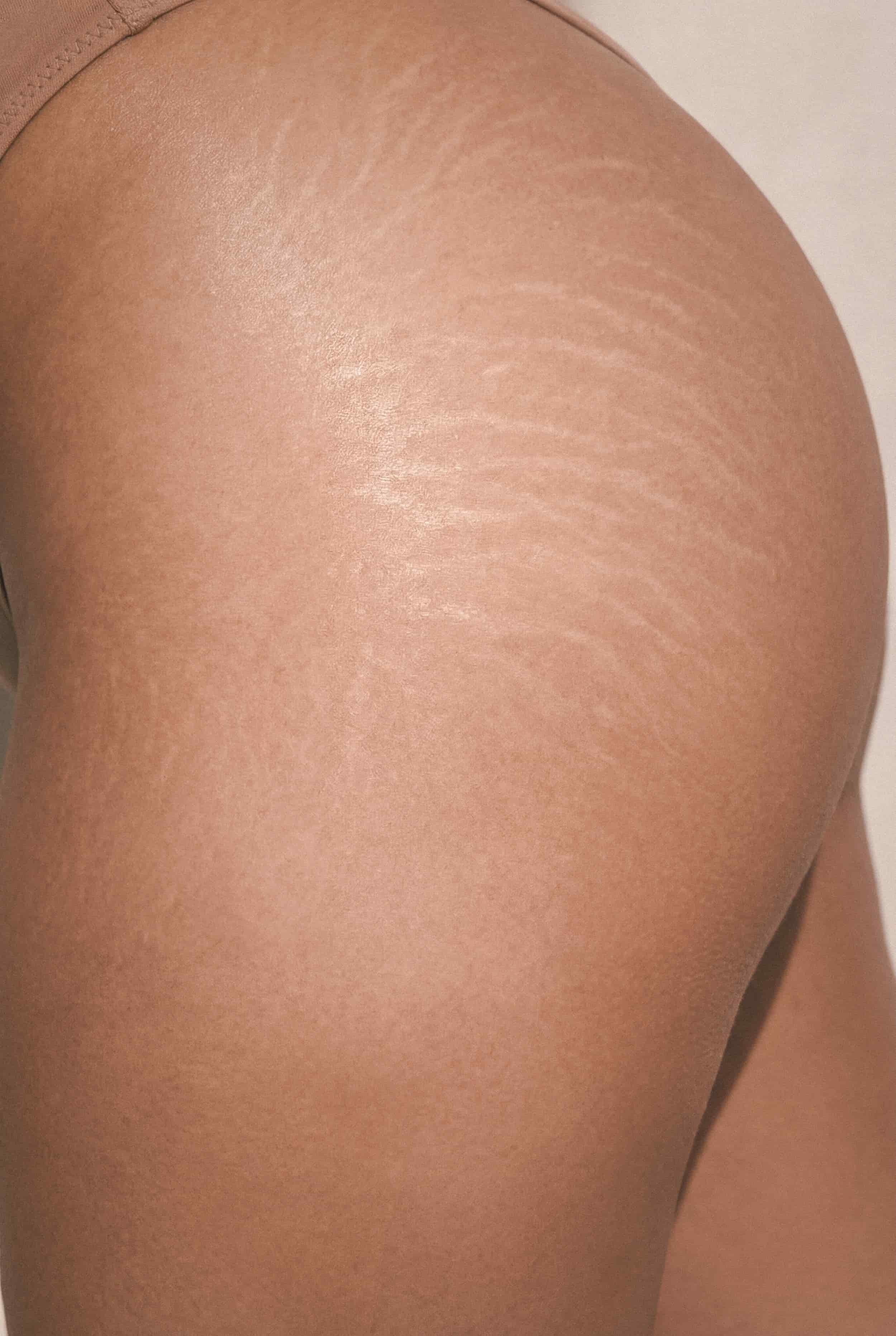 Stretch Mark Camouflage in Reno: A Natural Approach to Skin Restoration