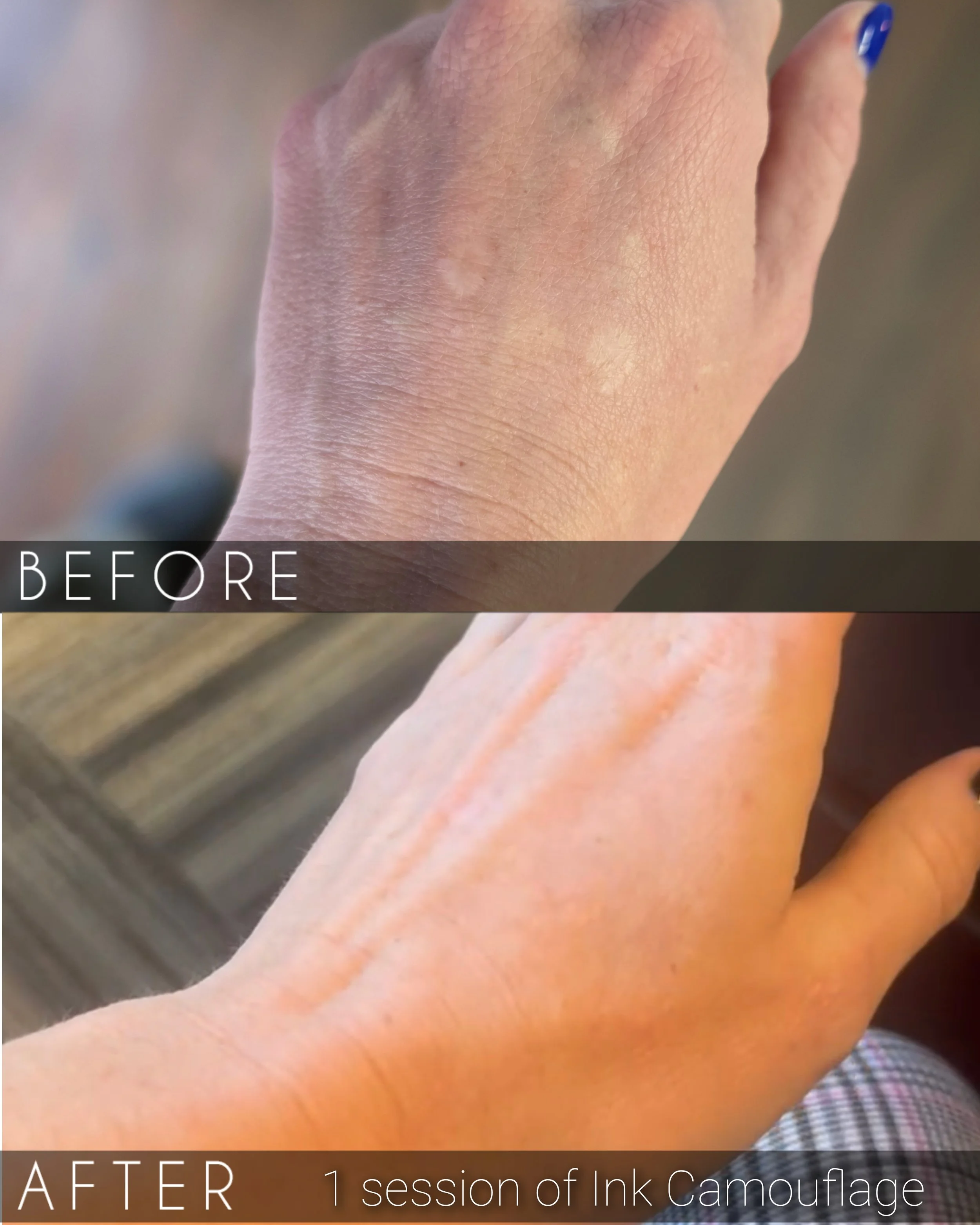 Comparison of a hand before and after one session of ink camouflage treatment. The before image shows darker, more pigmented skin, while the after image shows lighter, more natural skin tone with less visible ink.