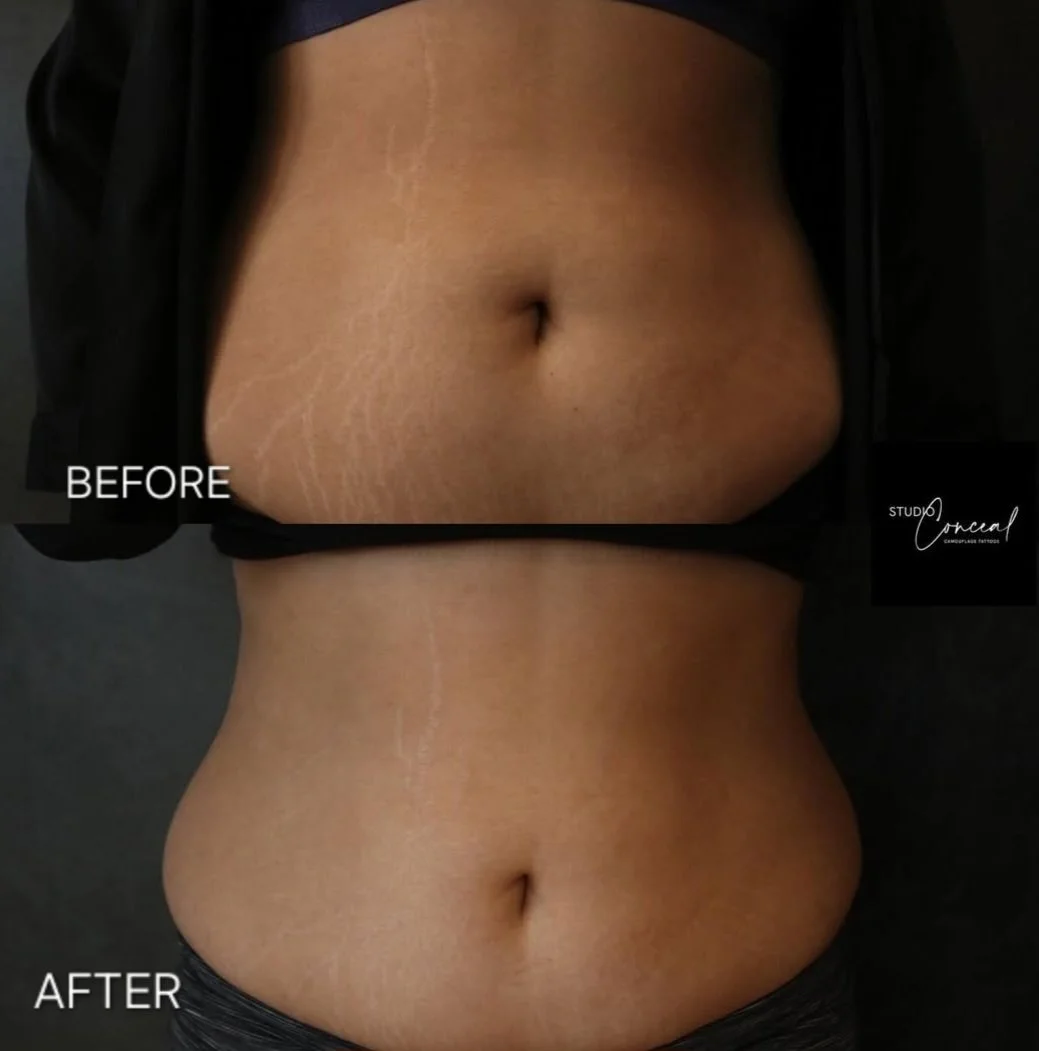 stretch mark camouflage Reno NV