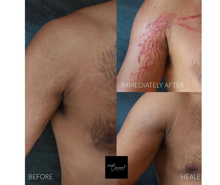 Stretch mark camouflage paramedical tattooing in Reno NV