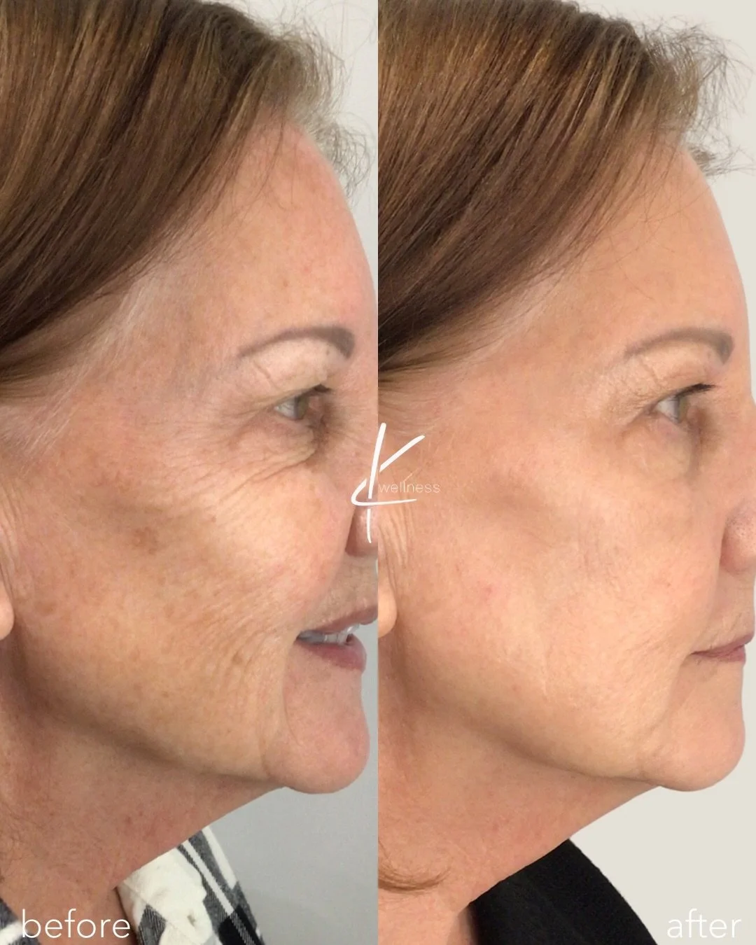Target pigmentation, improve texture, and rejuvenate your glow with BBL and MOXI