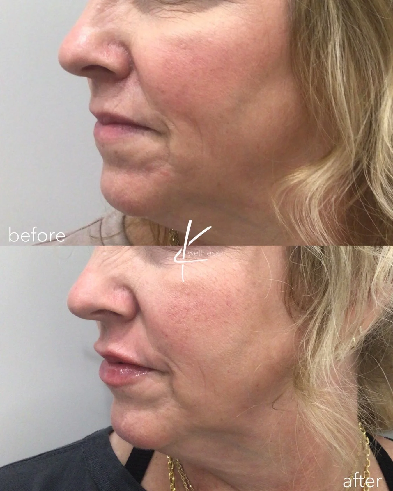 Together, Dysport and Restylane create a youthful lip aesthetic, with immediate results from Restylane and gradual effects from Dysport. 

Dysport relaxes muscles to reduce fine lines around the lips, while Restylane adds volume and hydration with hy