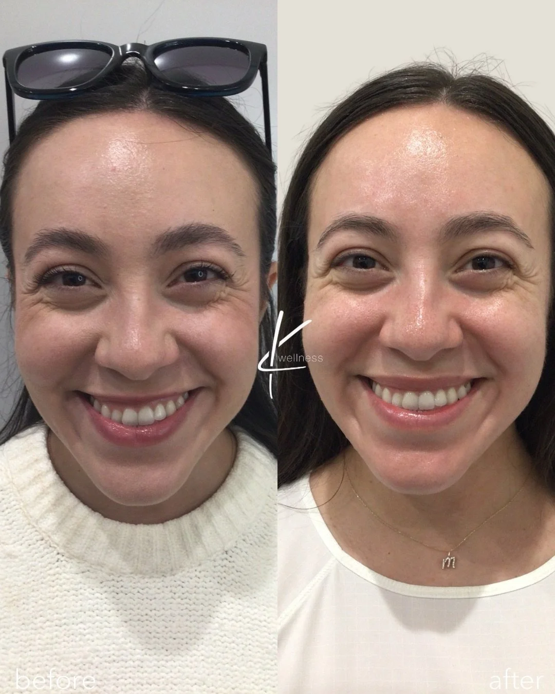 What is a Lip Flip?
A lip flip involves injecting a small amount of Dysport or Botox into the muscles around the lips. This causes the upper lip to relax and flip outward slightly, resulting in a fuller appearance.

Benefits of a Lip Flip

	&bull;Enh