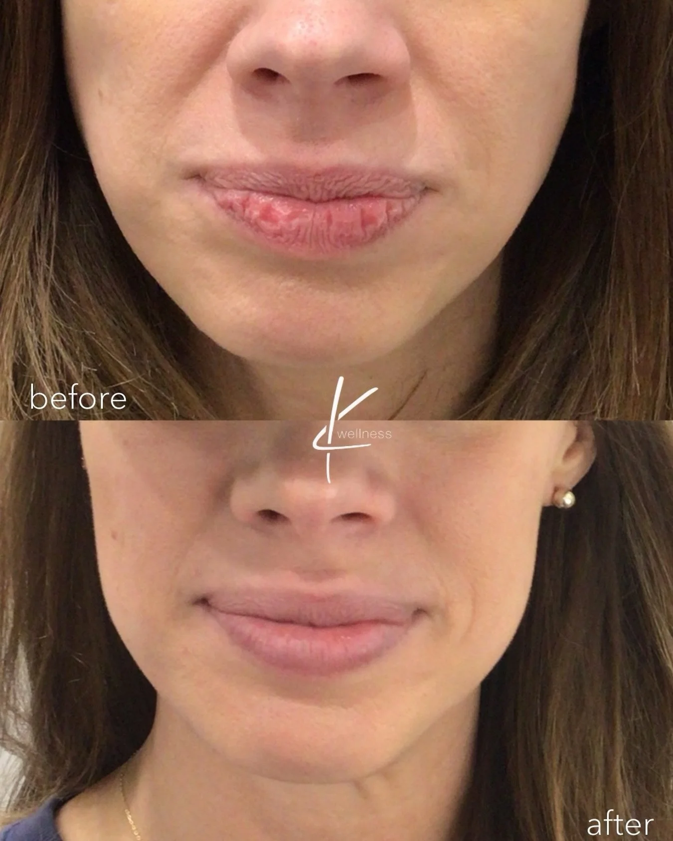 Kysse is an excellent option for anyone aiming to achieve beautifully hydrated lips while maintaining a natural aesthetic enhancement.