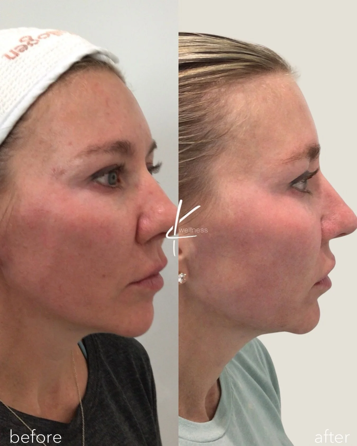 Experience the transformative effects of microneedling with SkinPen! 🌟 
This treatment utilizes tiny needles to create micro-injuries in the skin, stimulating collagen and elastin production. The result? Reduced fine lines and wrinkles, minimized po