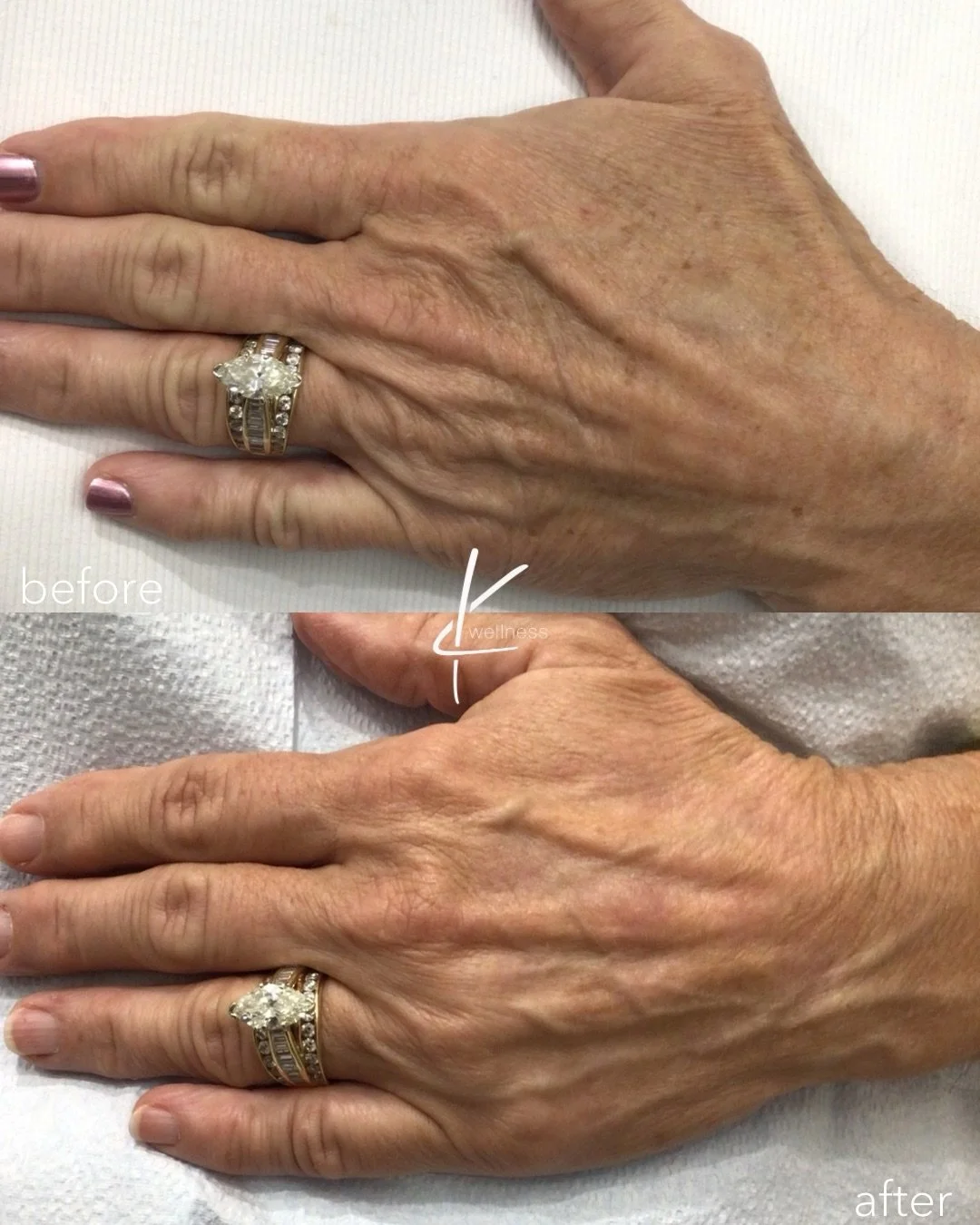 Before + After 1x Broad Band Light treatment on hands 

BroadBand Light (BBL) therapy is a non-invasive treatment that uses intense pulses of light to reverse signs of aging and sun damage on the hands. It improves skin tone and texture by fading age