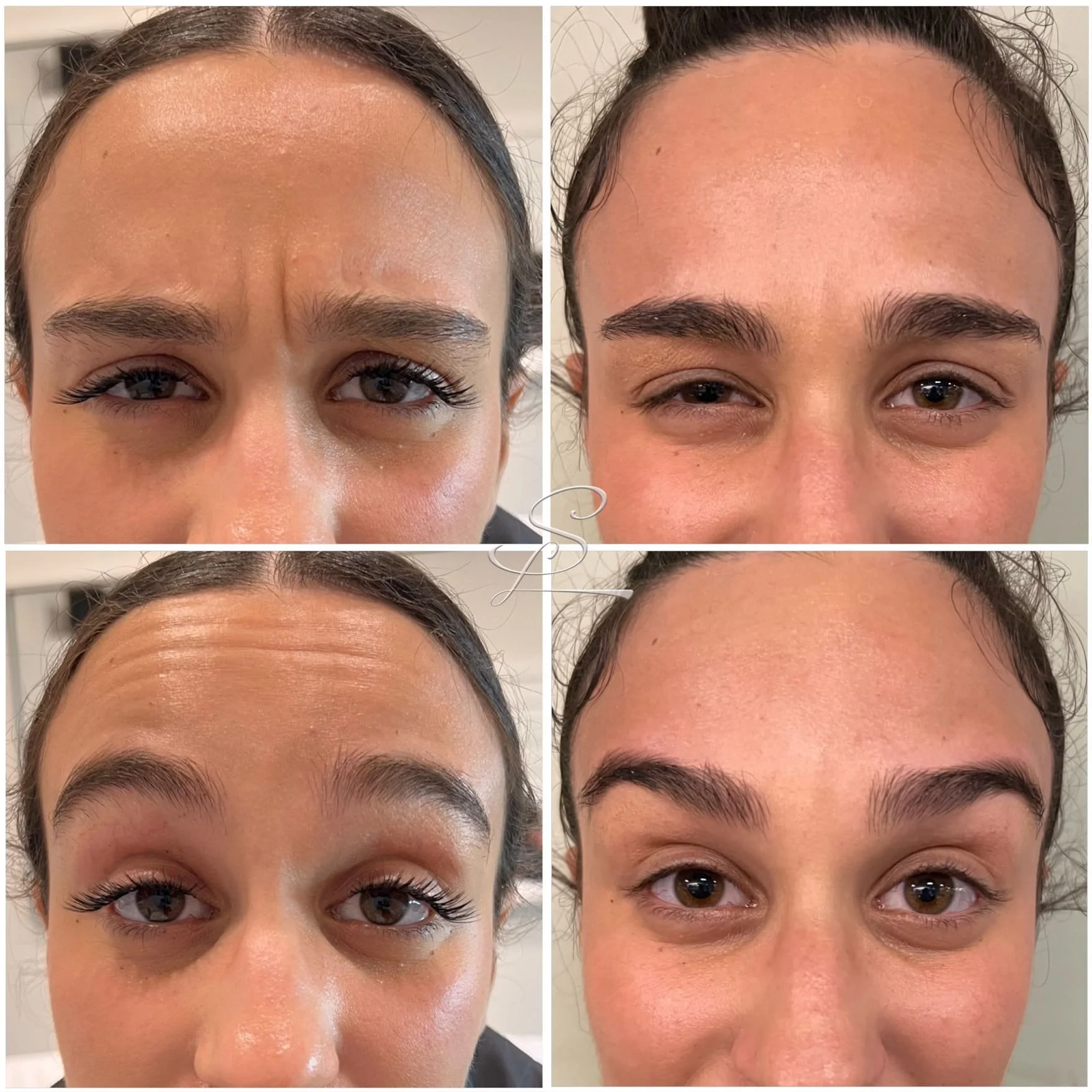 Comparative close-up photos of a woman's forehead, eyebrows, and eyes showing before and after results of a cosmetic treatment, with the top images depicting a furrowed brow and the bottom images showing a relaxed brow.