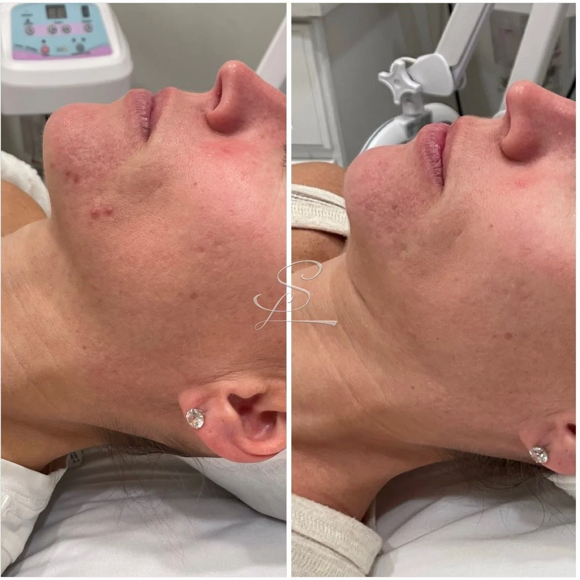 Side-by-side comparison of a woman's face before and after a skincare treatment, showing improved skin texture and reduced acne.