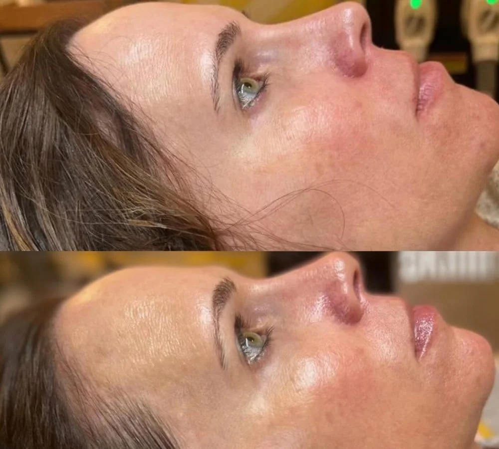 Before and after OxiVelour Oxygen Facial results showing clearer, more radiant skin at Spa Larimar New Bedford MA