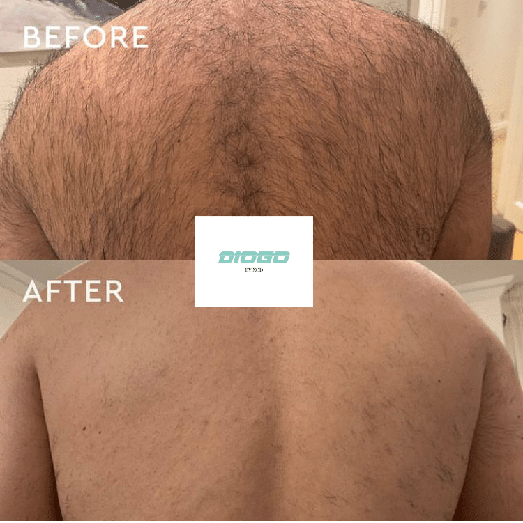 Comparison of a man's back before and after Diogo laser hair removal treatment. The top shows a hairy back labeled 'Before,' and the bottom shows a smooth, hair-free back labeled 'After.'