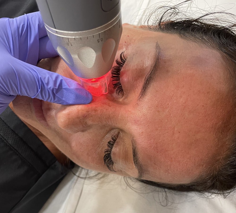 Close-up of a woman receiving a Microneeding RF treatment near her nose with the Pixel8 device emitting red light, while lying down with eyes closed.