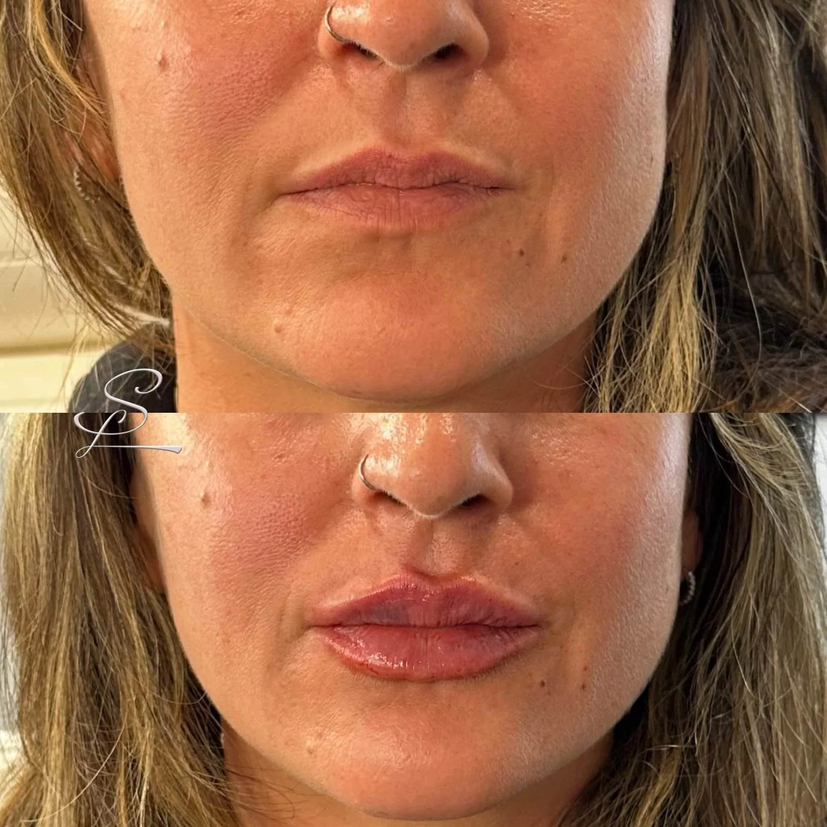 Close-up of a woman's face showing before and after lip enhancement.