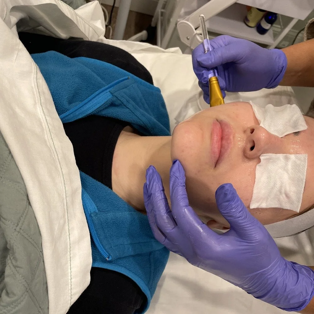 Person receiving a cosmetic injection in their cheek area from a healthcare professional wearing purple gloves, in a medical setting.
