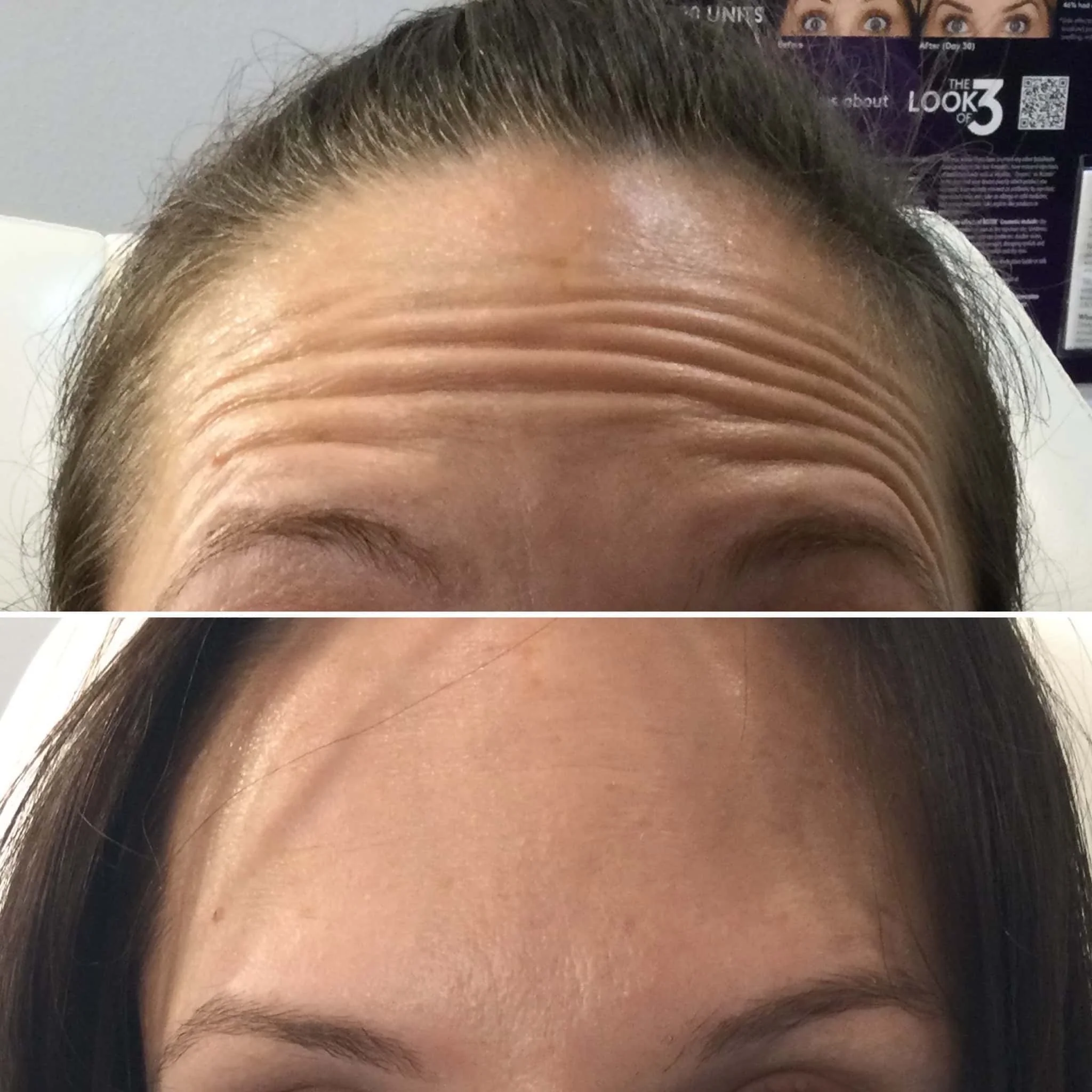 Comparison photo showing forehead wrinkles before and after treatment, with the top image displaying prominent horizontal lines and the bottom image showing a smoother forehead.