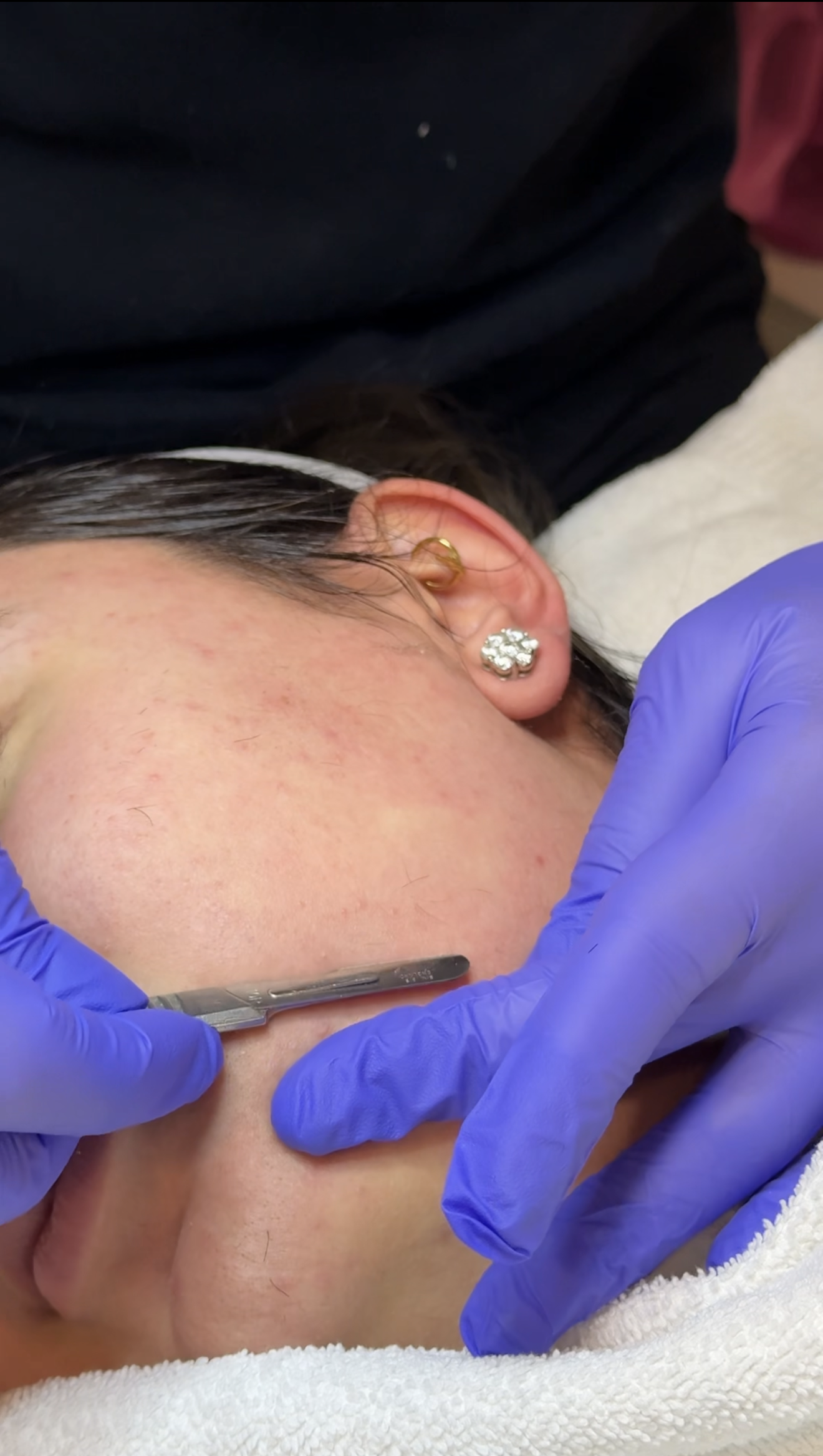 A person lying down receiving a cosmetic or dermaplane treatment, with a gloved hand using a scalple on their cheek. The person has multiple earrings and a white headband.
