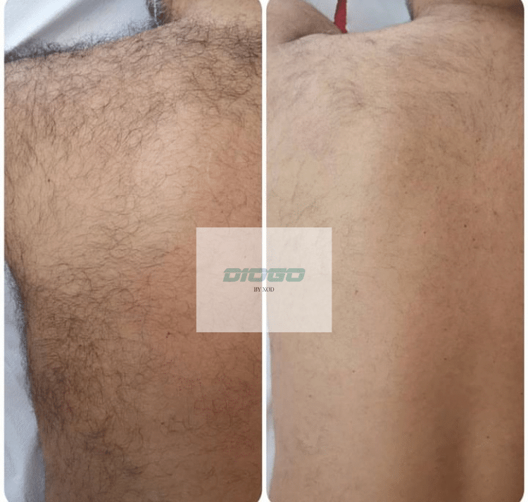 Comparison of a person's back before and after Diogo Laser hair removal, showing reduced hair after treatment