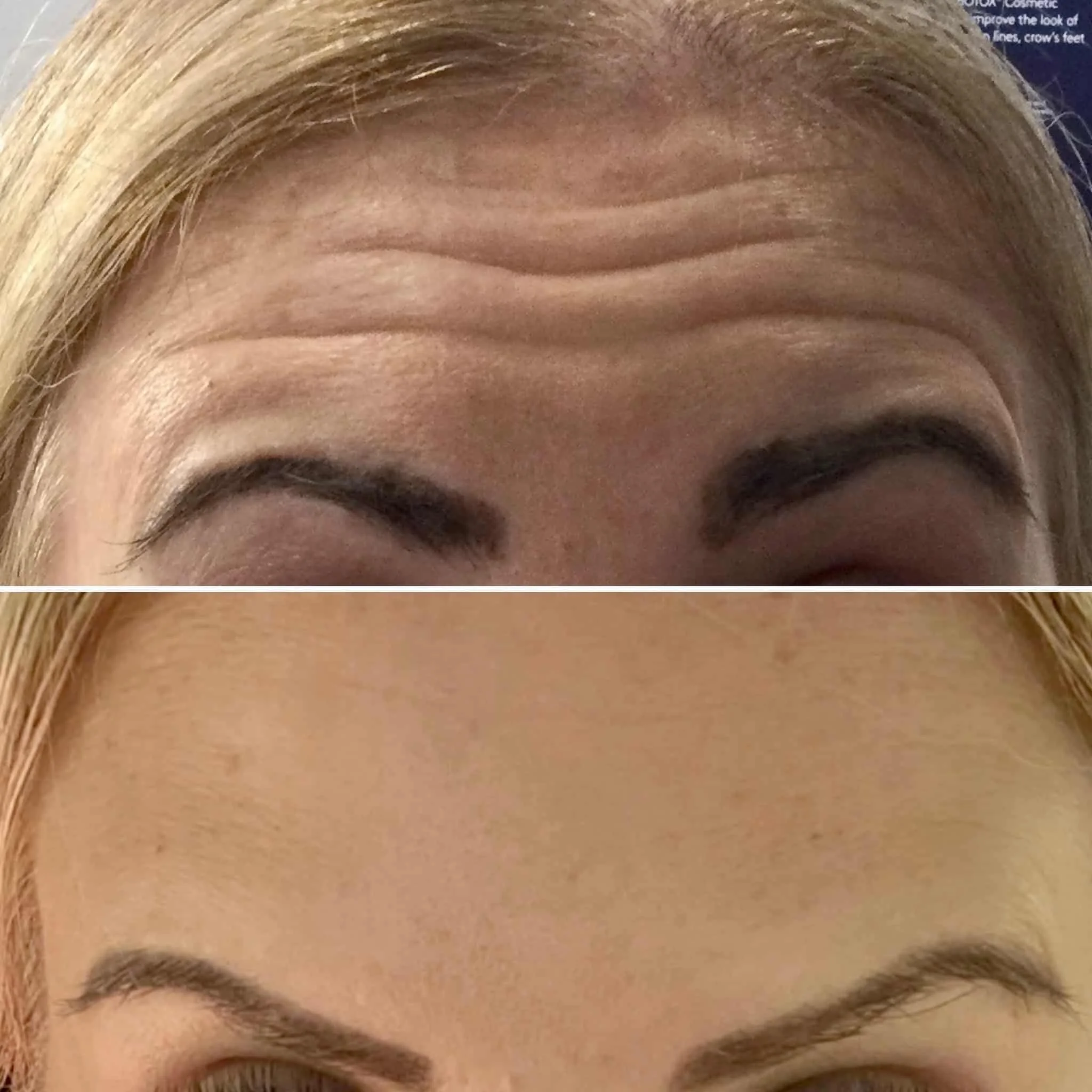 A close-up of a person's forehead and eyebrows before and after wrinkle treatment, showing reduced forehead lines in the after image.