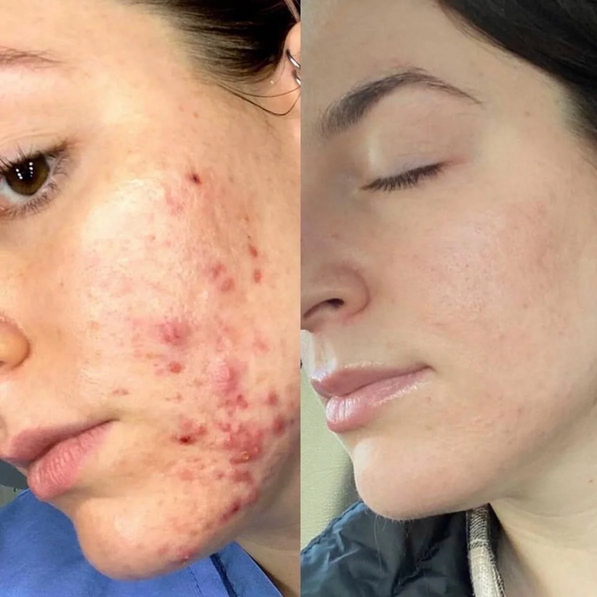 Side-by-side comparison of a woman's face showing acne before and after skin treatment.