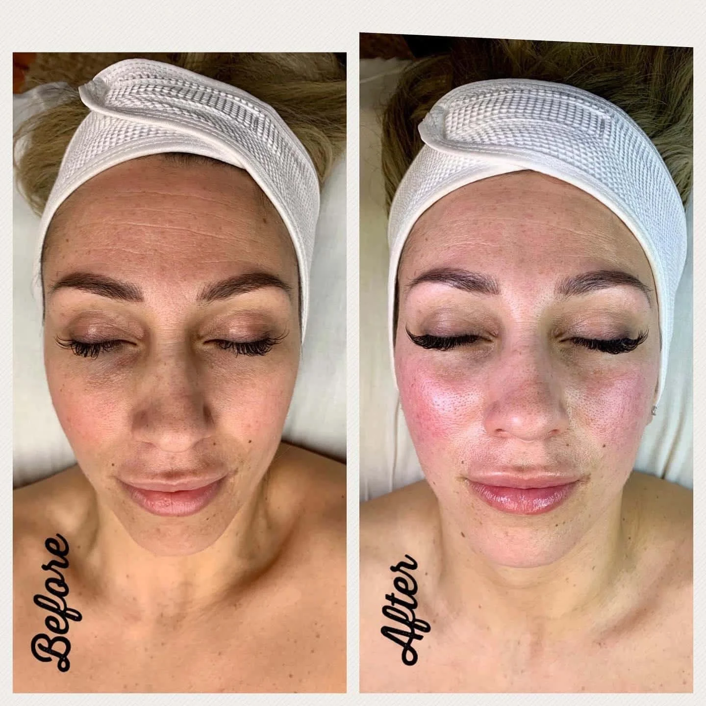 Side-by-side comparison of a woman's face before and after skincare treatment, showing clearer skin with reduced redness post-treatment, both images taken during a spa session with a white headband and closed eyes.