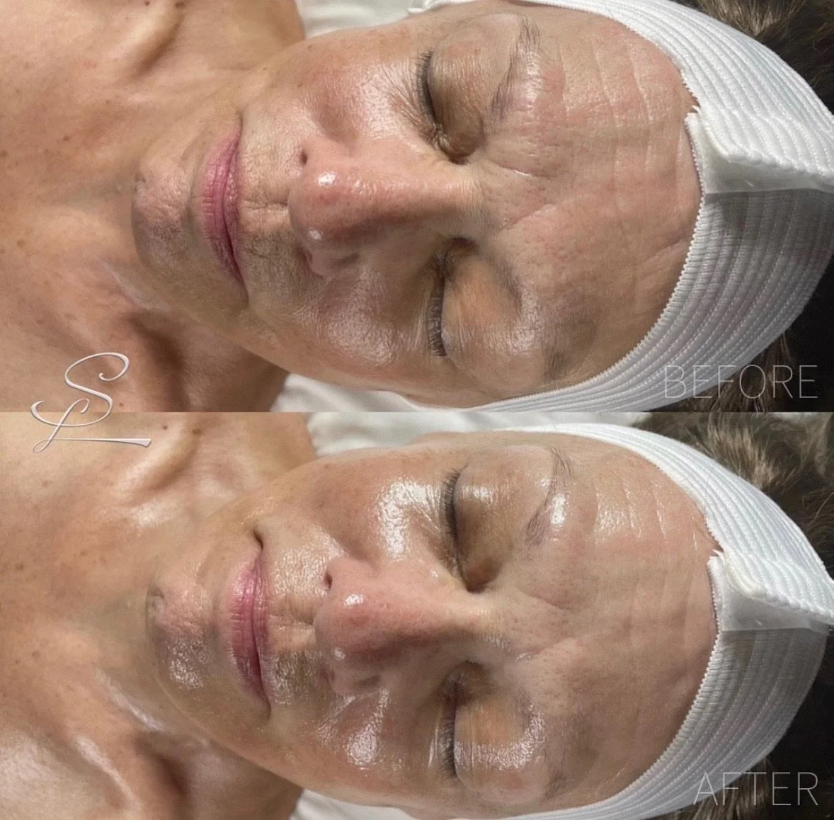 Comparison of a woman's face before and after skincare treatment, showing smoother skin post-treatment.