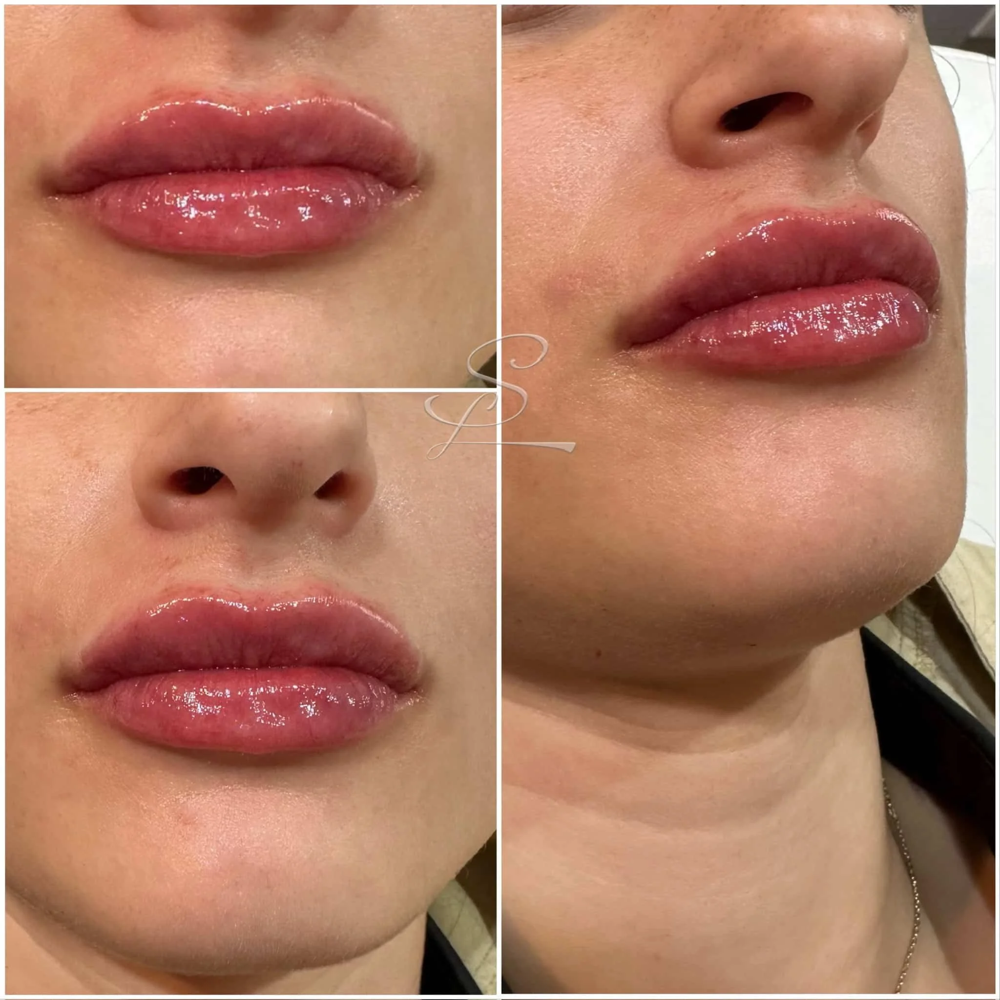 Close-up view of a woman's lips before and after lip augmentation, showing improved fullness and shape, with glossy finish.