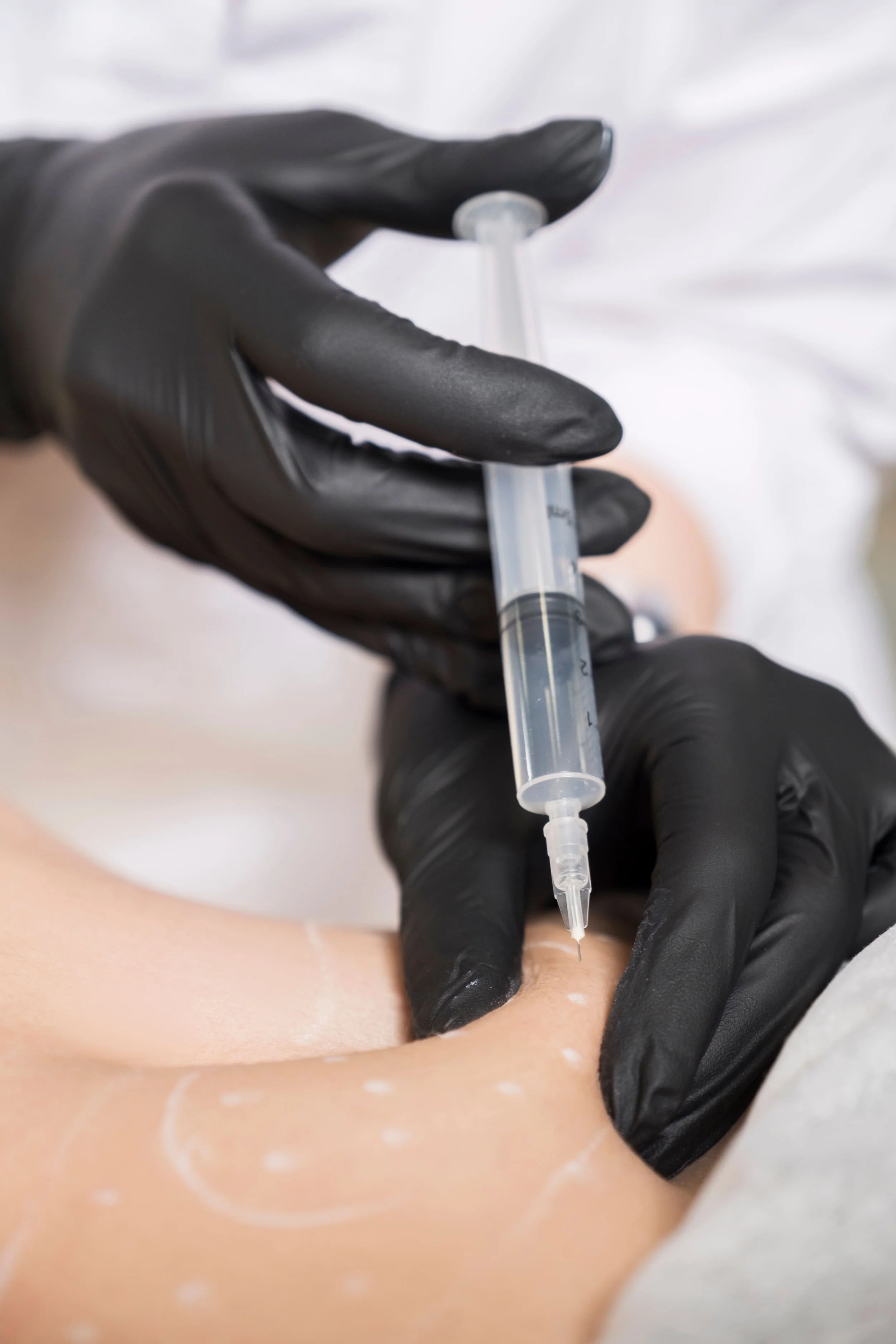 Praticien en train d'injecter un traitement sous la peau d'un patient avec une seringue équipée d'une aiguille, portant des gants noirs, le patient est allongé avec des marques de préparation sur la peau.
