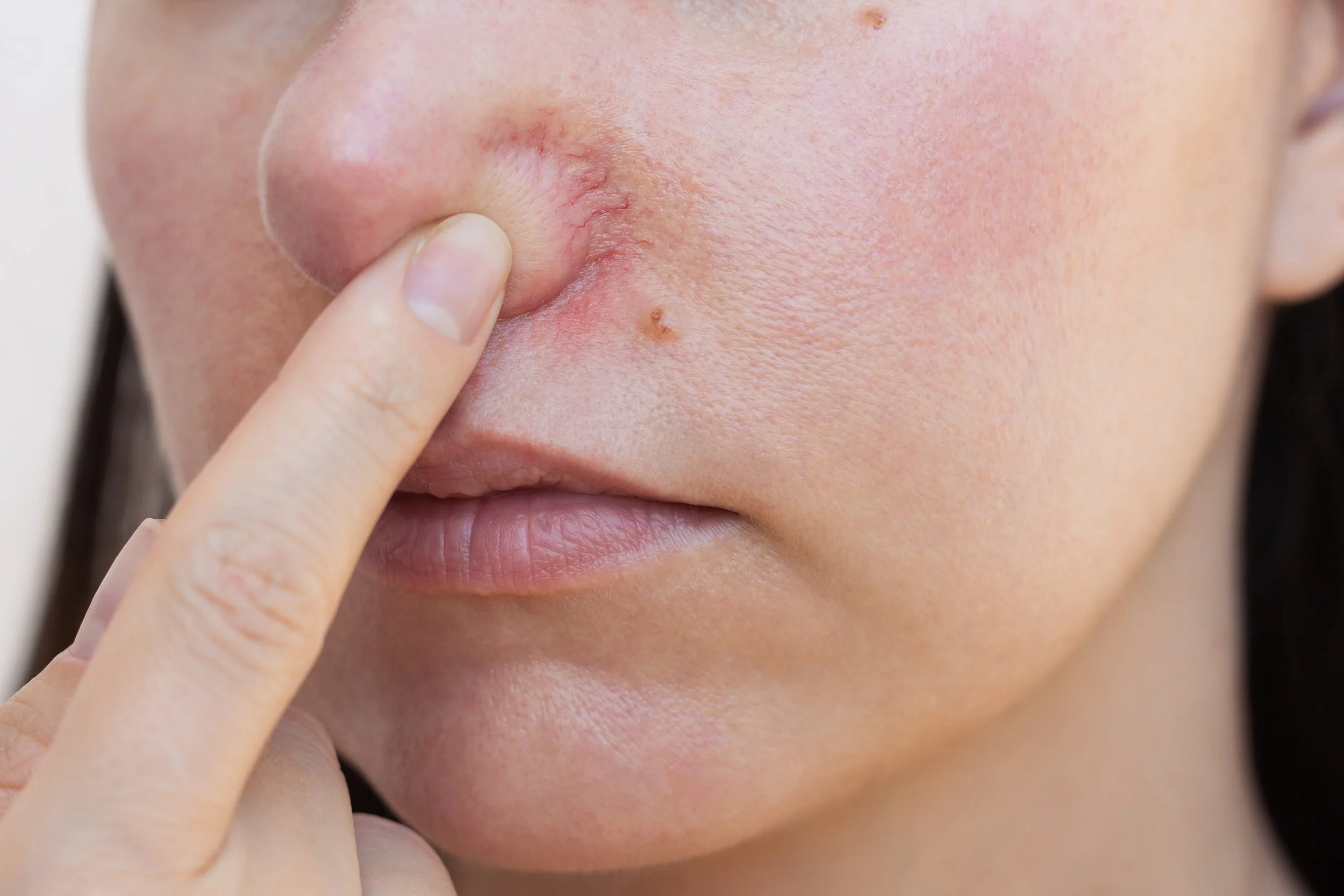 Gros plan du visage d'une femme avec une main qui touche un bouton de boutonnière sur son menton, montrant une peau claire avec des pores visibles, certaines imperfections et une petite bosse.