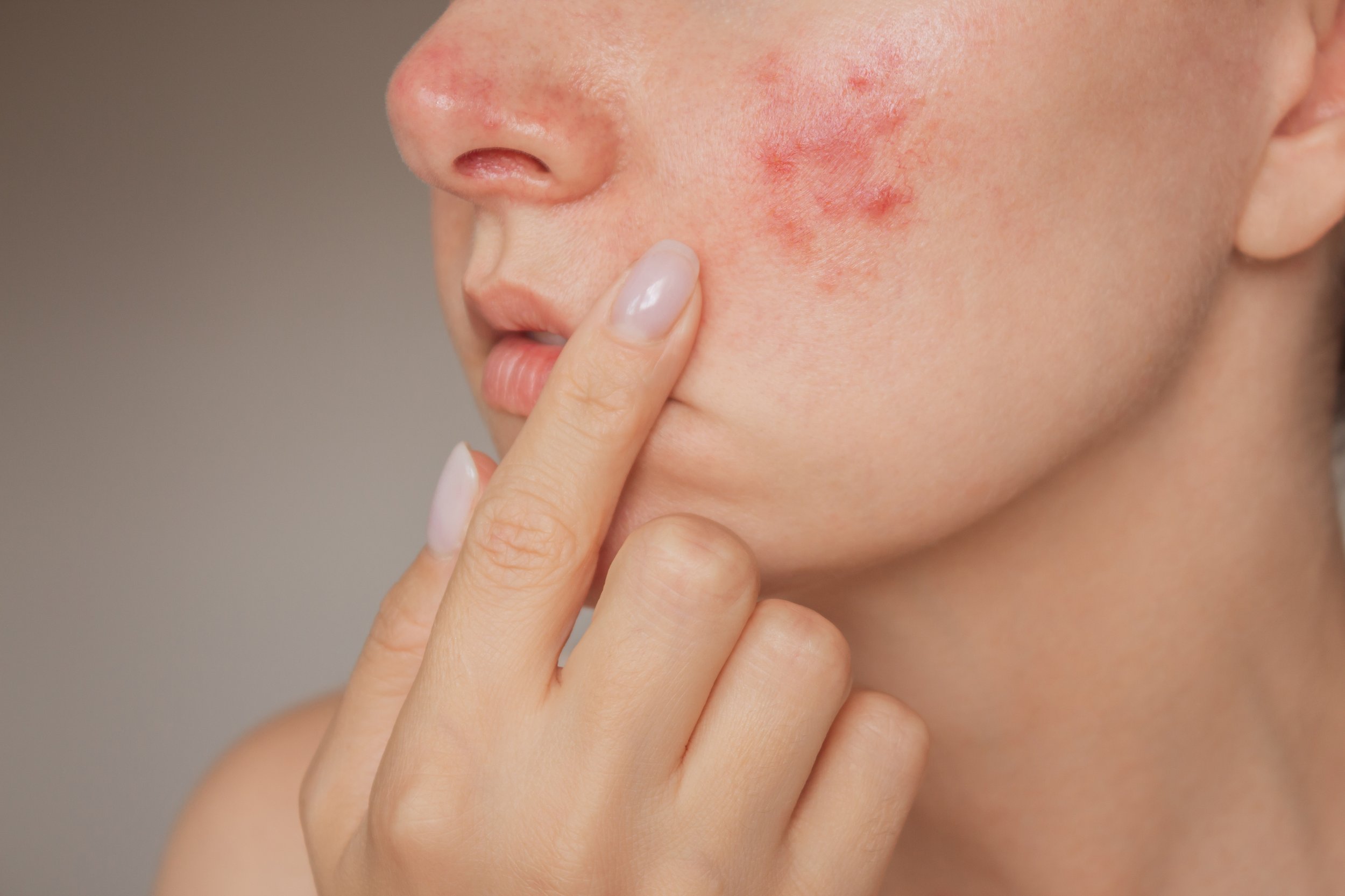 Une main touche la joue d'une personne avec des boutons ou une irritation rouge sur la peau.