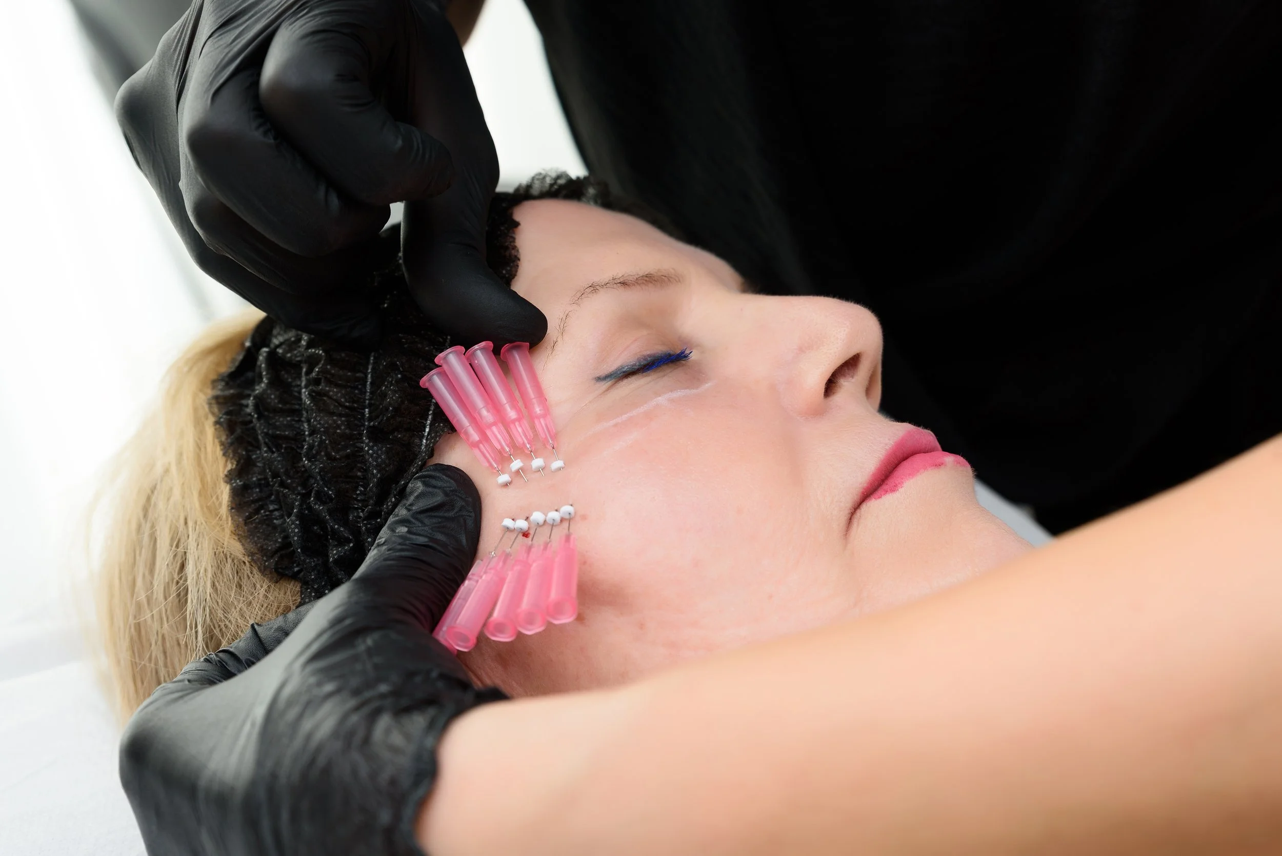 Une femme reçoit un traitement de microneedling ou dermaroller sur le visage, avec des aiguilles roses, pendant une séance esthétique. La praticienne porte des gants noirs et soignée la peau de la cliente, qui se repose avec les yeux fermés.
