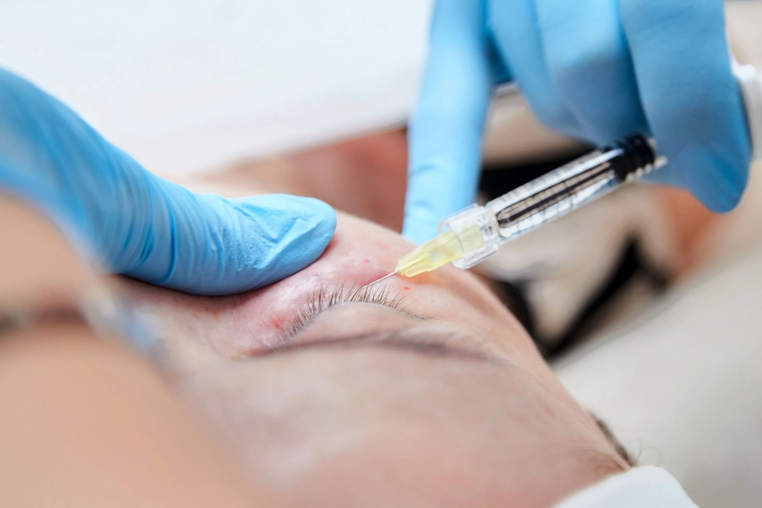 Une personne est en train de recevoir une injection sous la peau, probablement un vaccin, avec un professionnel portant des gants en latex bleus.