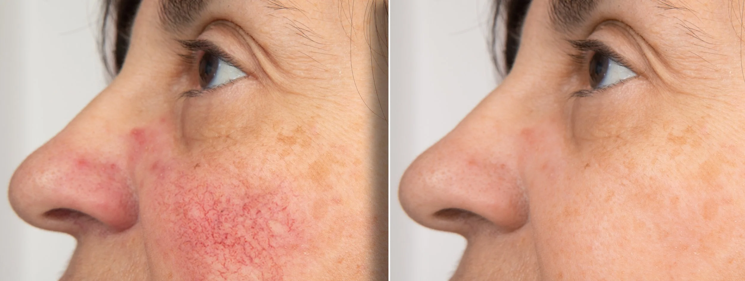 Comparaison entre le visage d'une femme avec des rougeurs et des imperfections cutanées sur la joue gauche, et le même visage après traitement avec une peau plus claire et sans rougeurs.