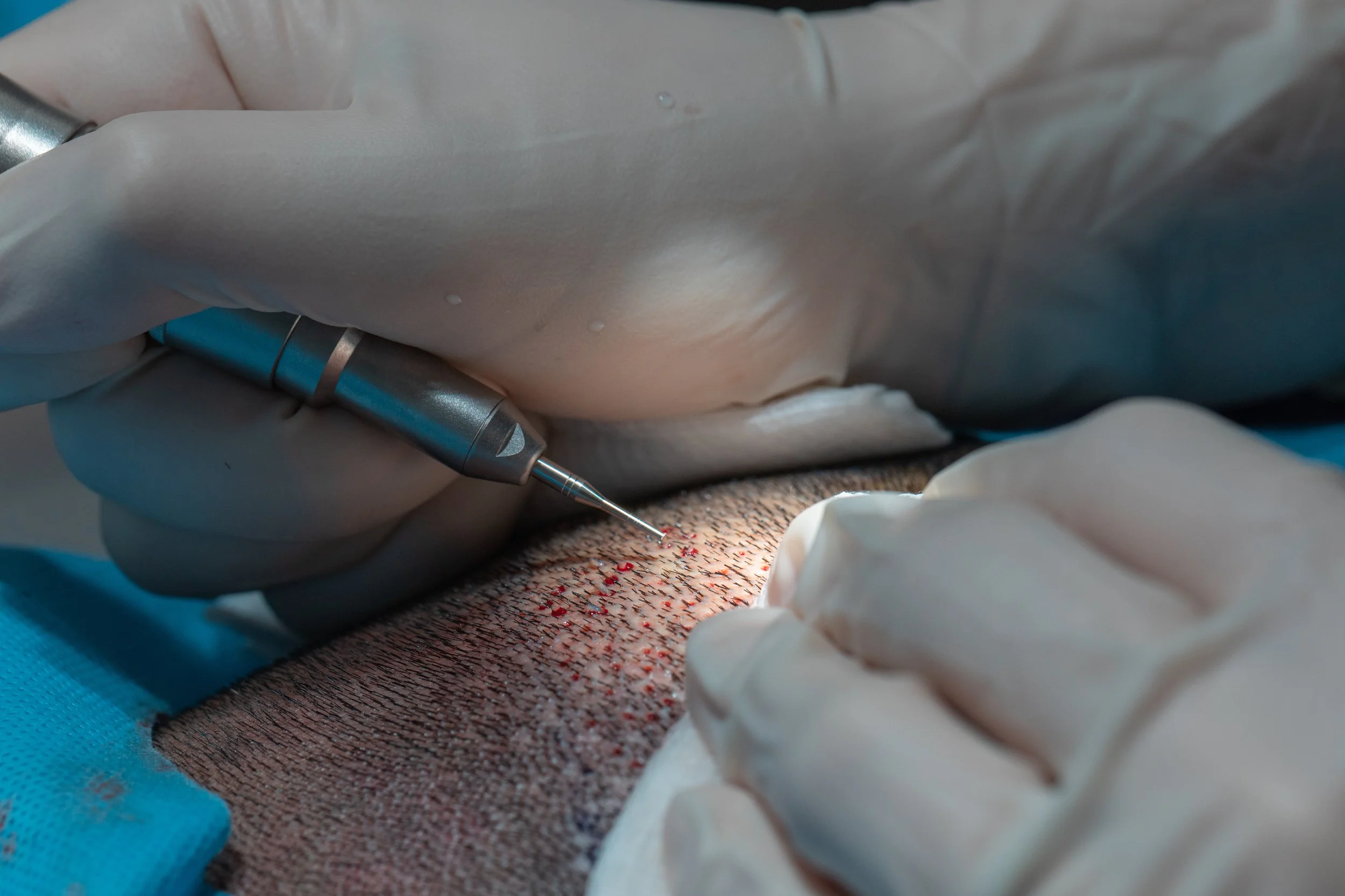 Une procédure médicale sur une peau, avec un professionnel portant des gants utilisant un instrument pour une intervention précise.