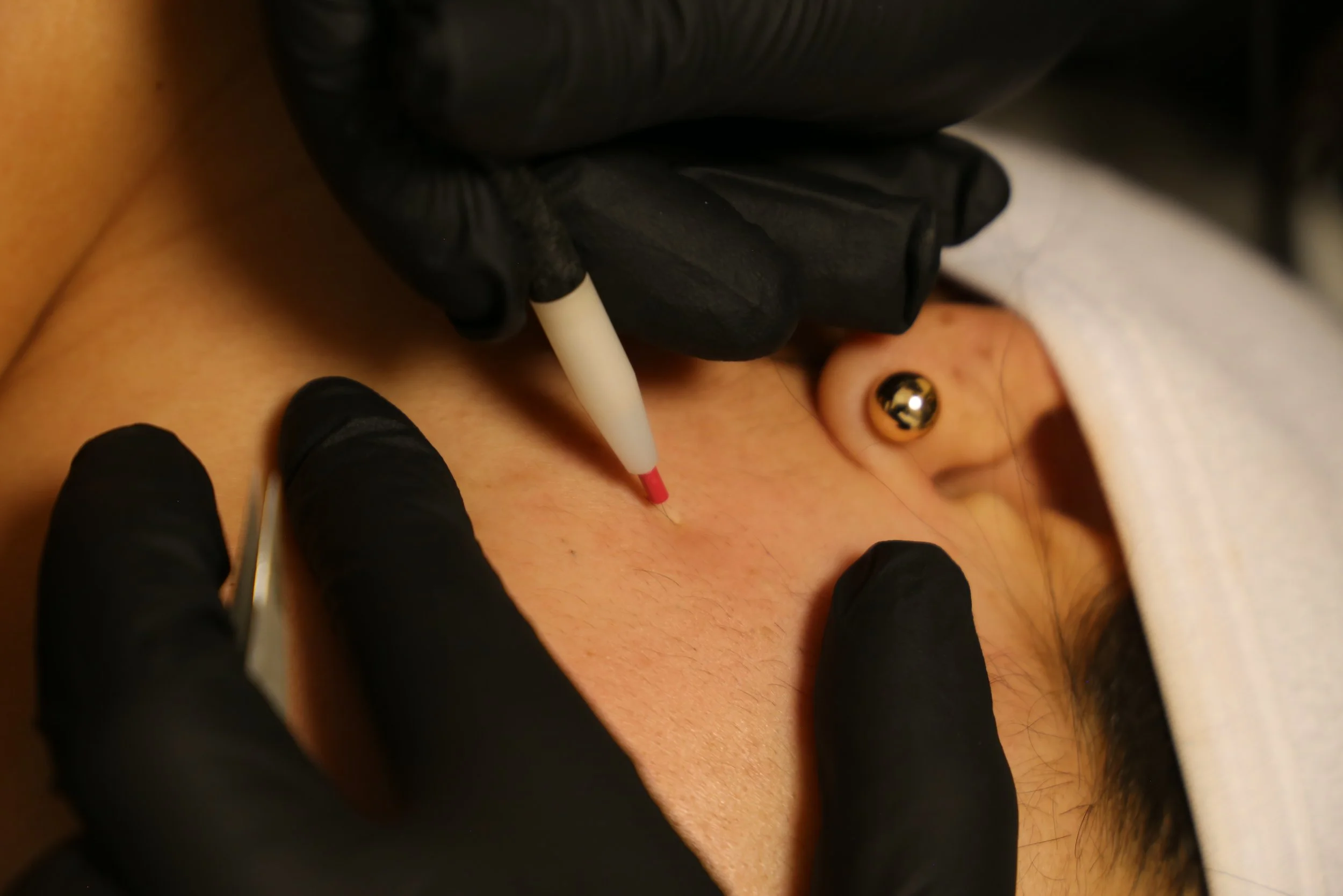 Une procédure médicale où un professionnel utilise une aiguille pour une injection ou un prélèvement sur un patient, avec des gants noirs et un coussin ou un drap blanc en arrière-plan.