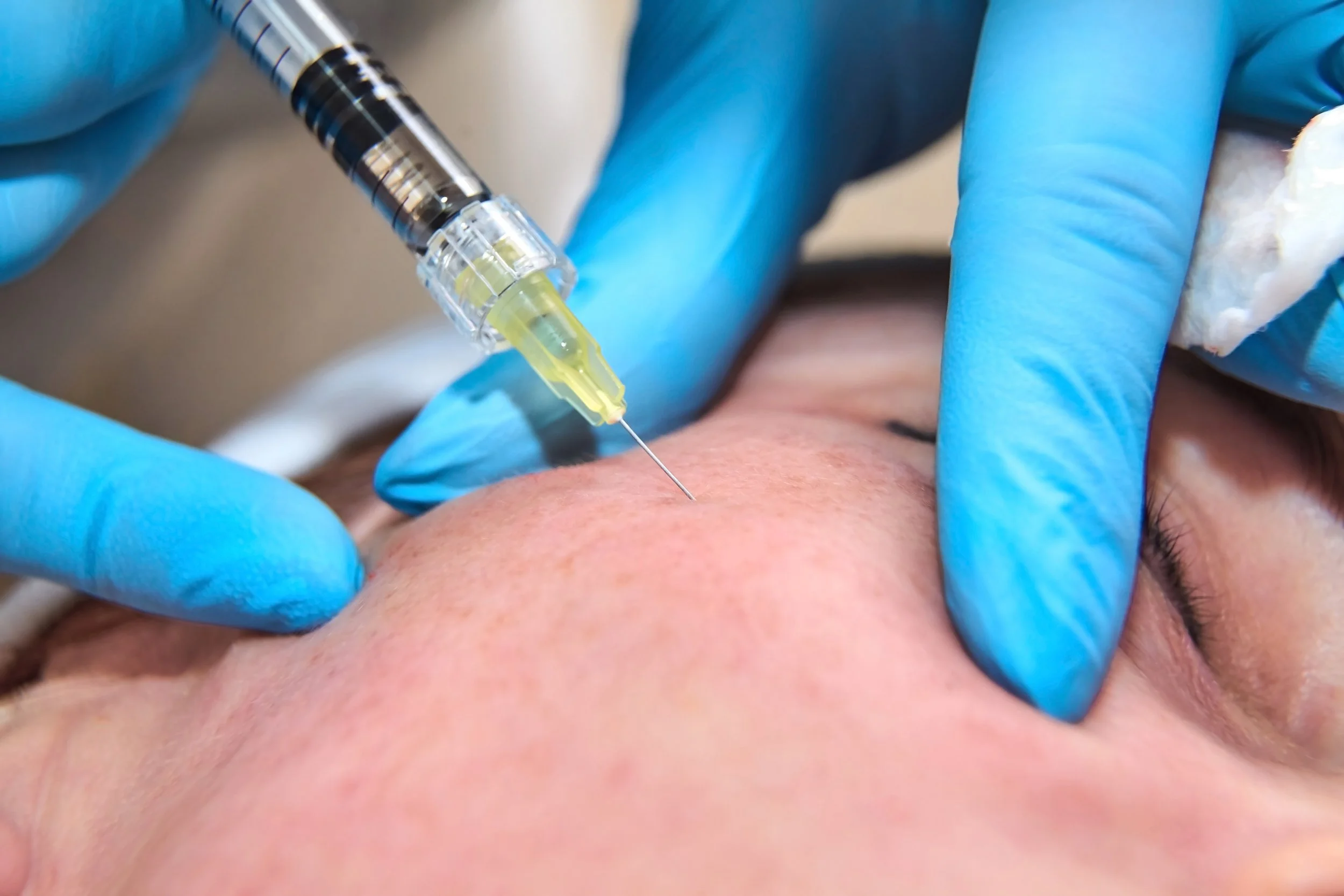 Une personne reçoit une injection sous la peau pendant la procédure.