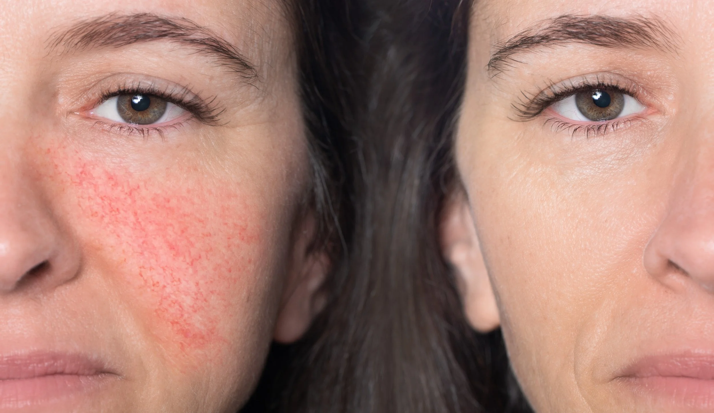 Deux visages masculins proches, l'un avec une peau rouge et irritée, l'autre avec une peau claire, sans imperfections visible.