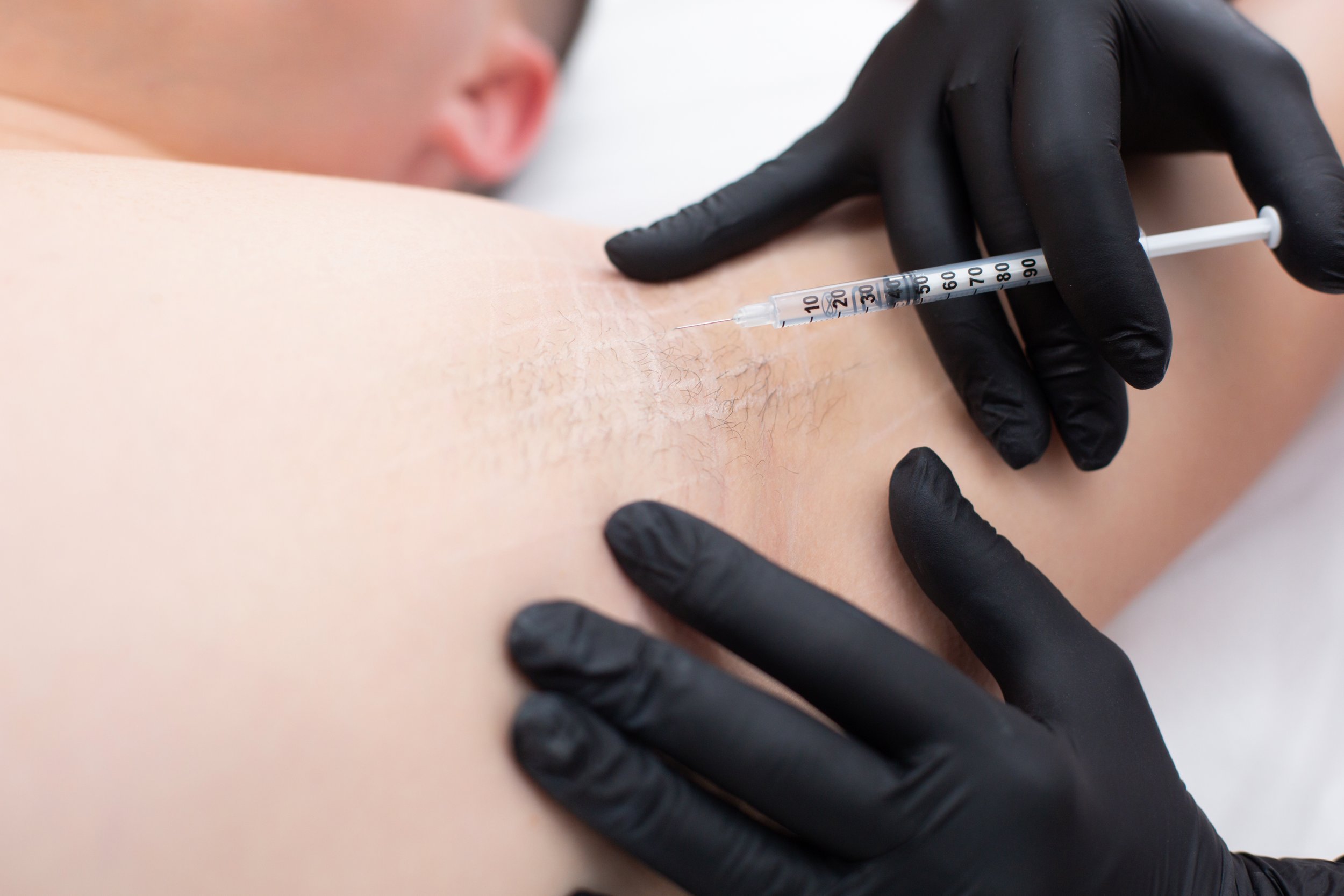Une personne, dont le visage est partiellement visible, reçoit une injection dans le bras. La personne qui administre l'injection porte des gants noirs.