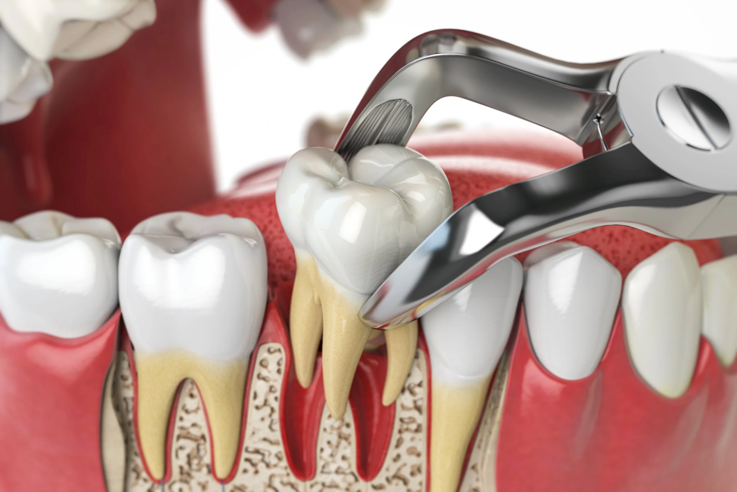 A dental procedure showing a tooth with dental tools cleaning or examining it, surrounded by other teeth and gums.