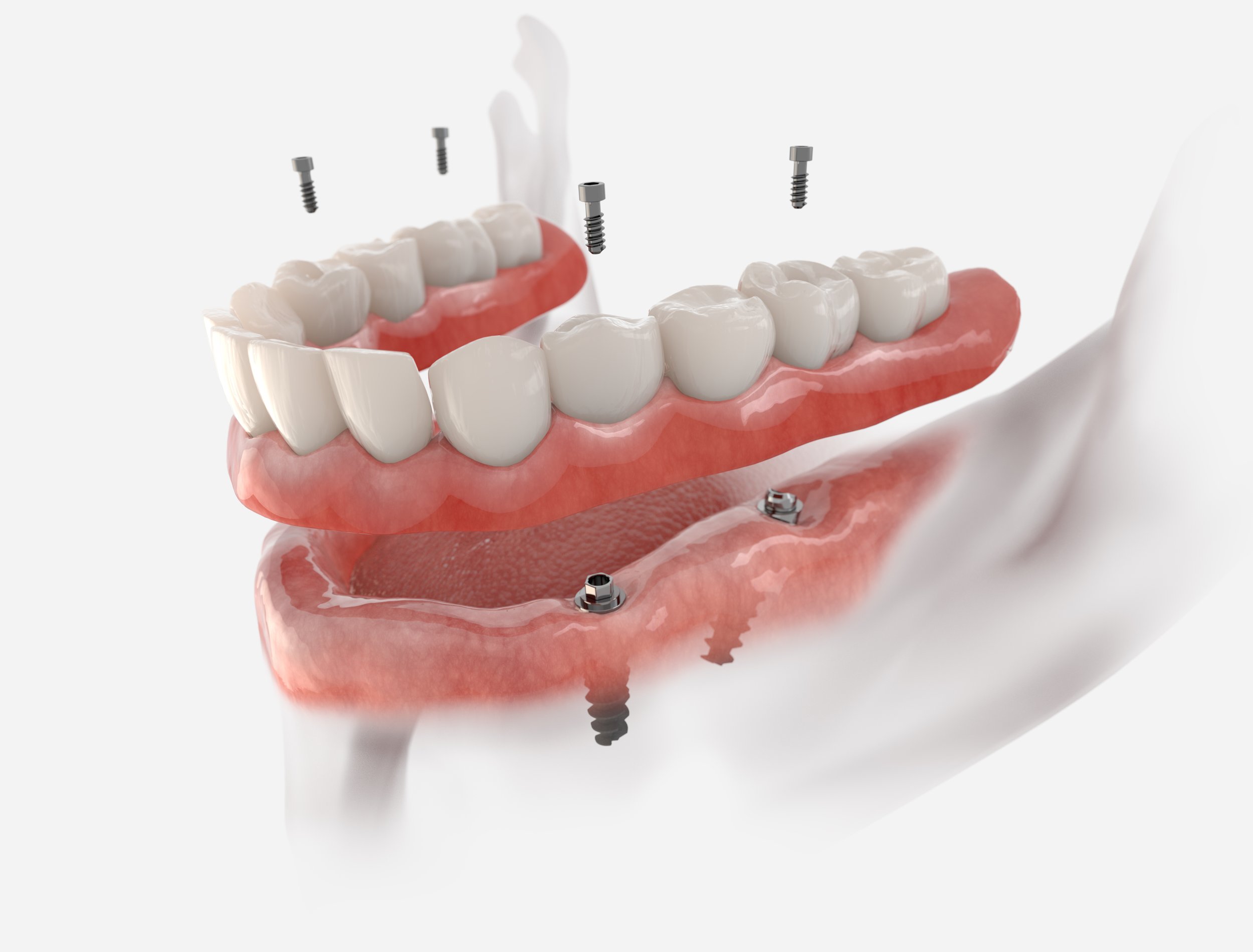 An illustration showing dental implants with a set of artificial teeth, screws, and a removable denture being attached to the jawbone.