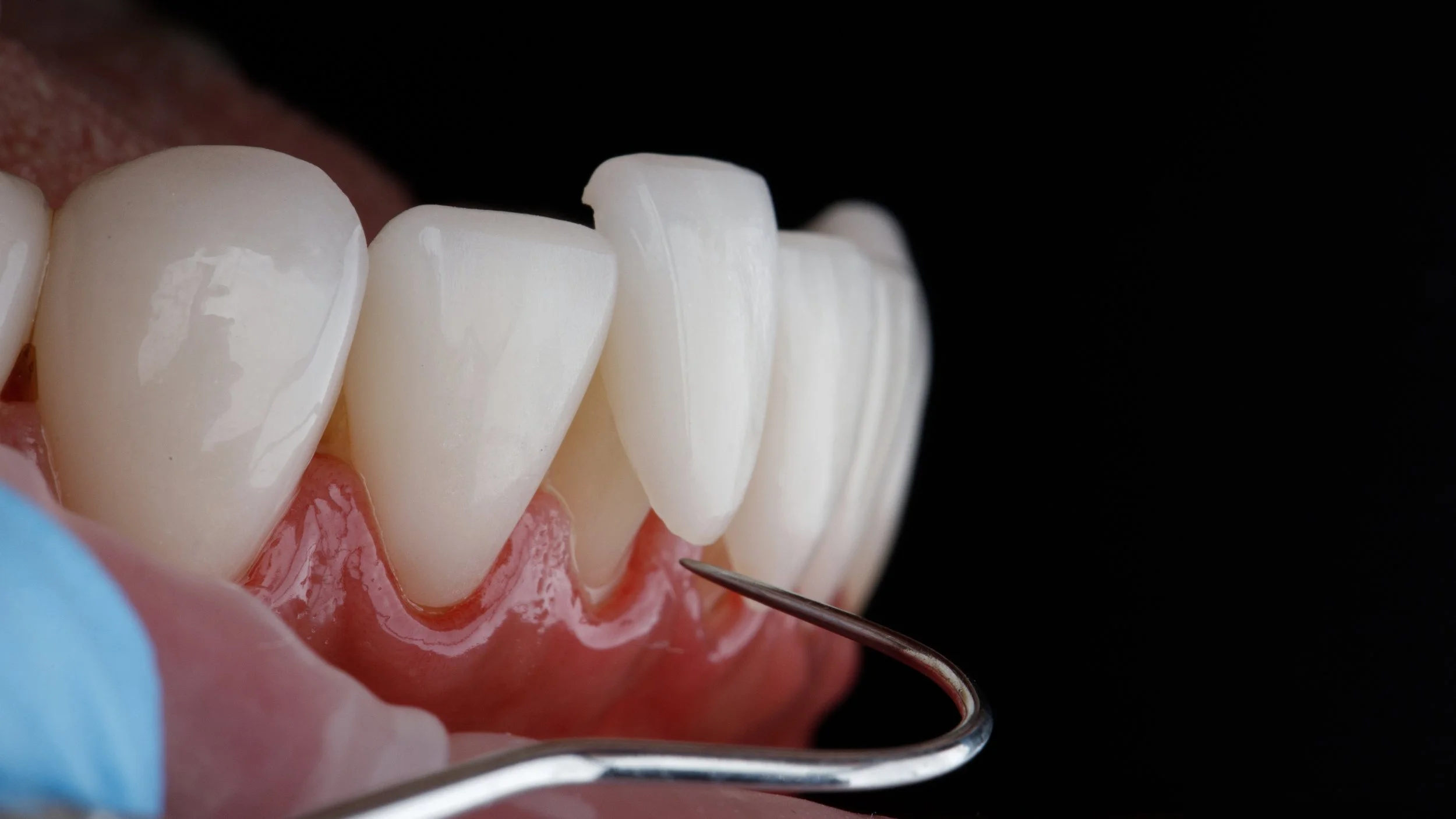 Close-up of a dental model showing upper front teeth and gums with a dental tool examining the gums