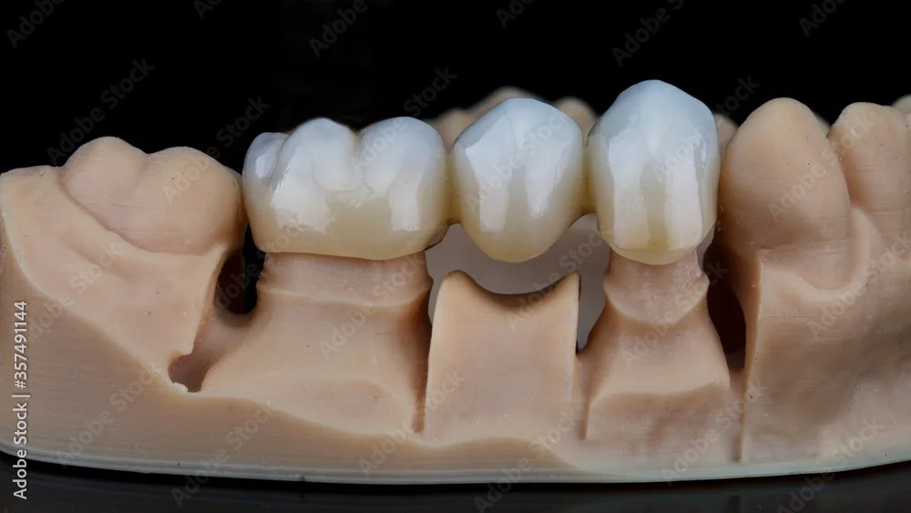 A dental model with a dental bridge replacing missing teeth.