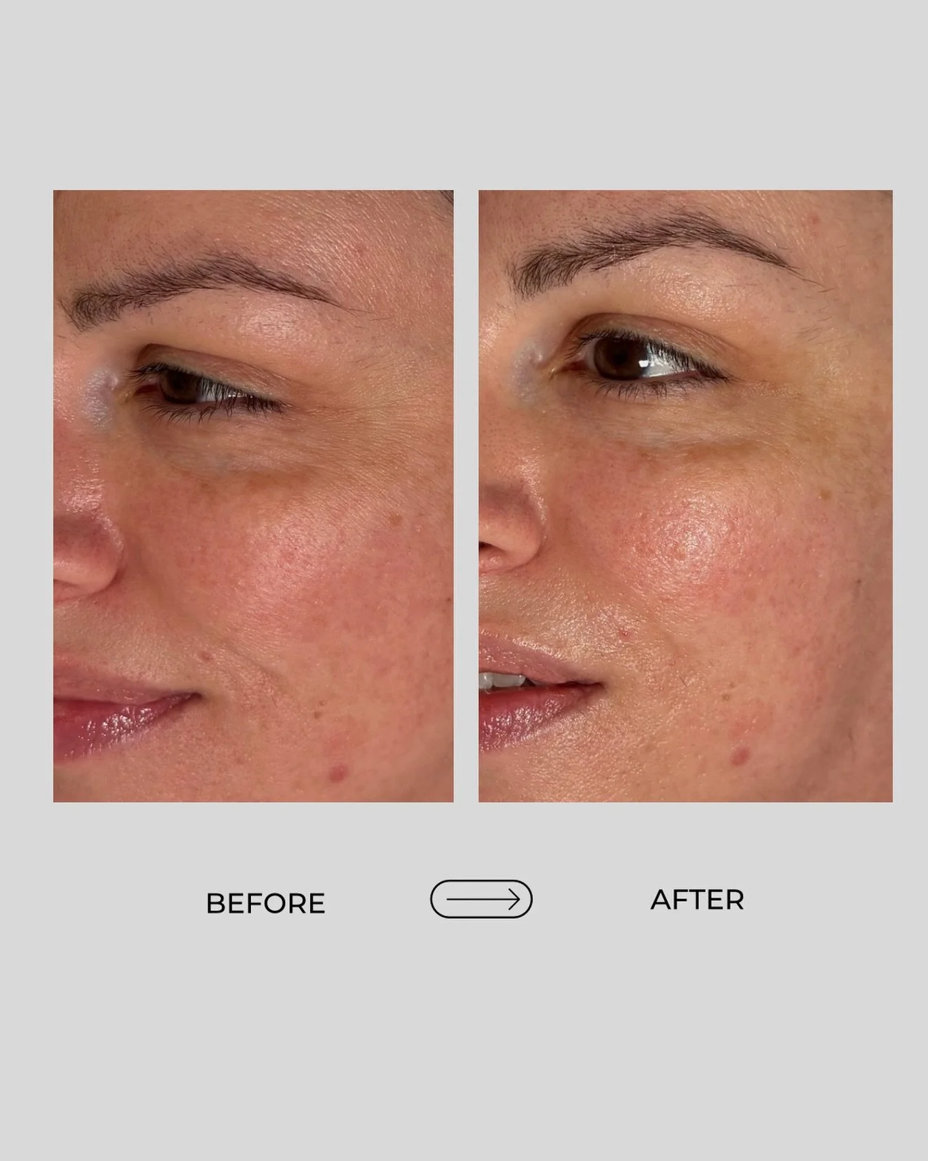 Healthy skin isn&rsquo;t about perfection&mdash;it&rsquo;s about supporting your skin with the right treatment plan, consistency, and home care.

This result was captured immediately following a customized facial focused on calming the skin, supporti