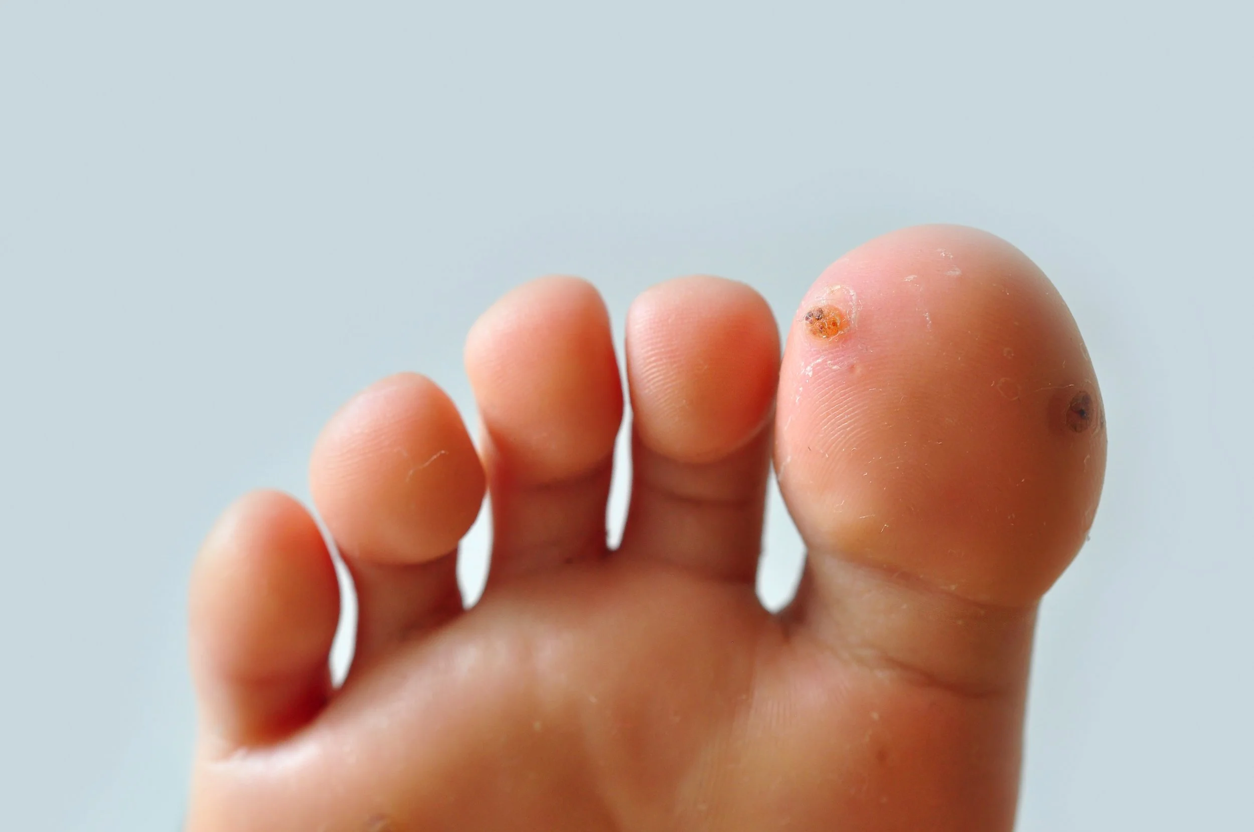 Plantar Warts (Verrucae) in Children