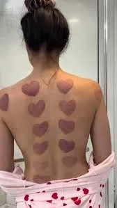 Images for fire cupping .jpeg