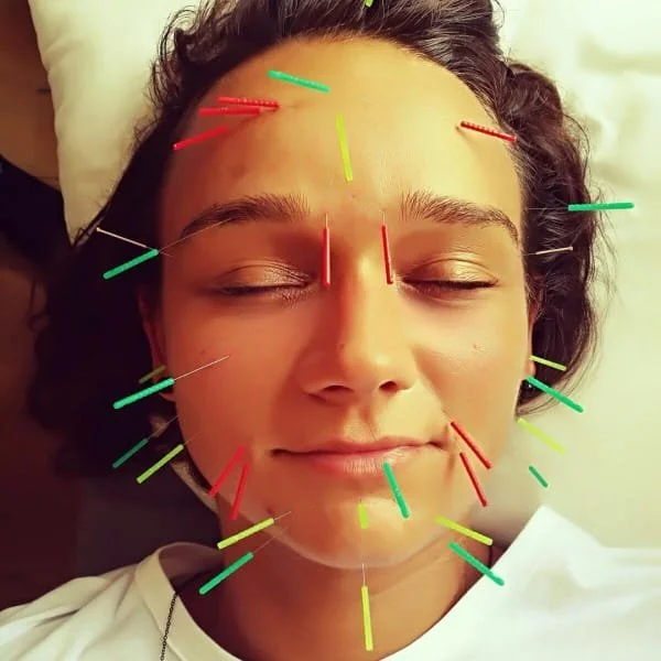 Facial Acupuncture .jpg