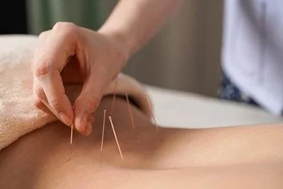 Acupuncture 2 .jpg